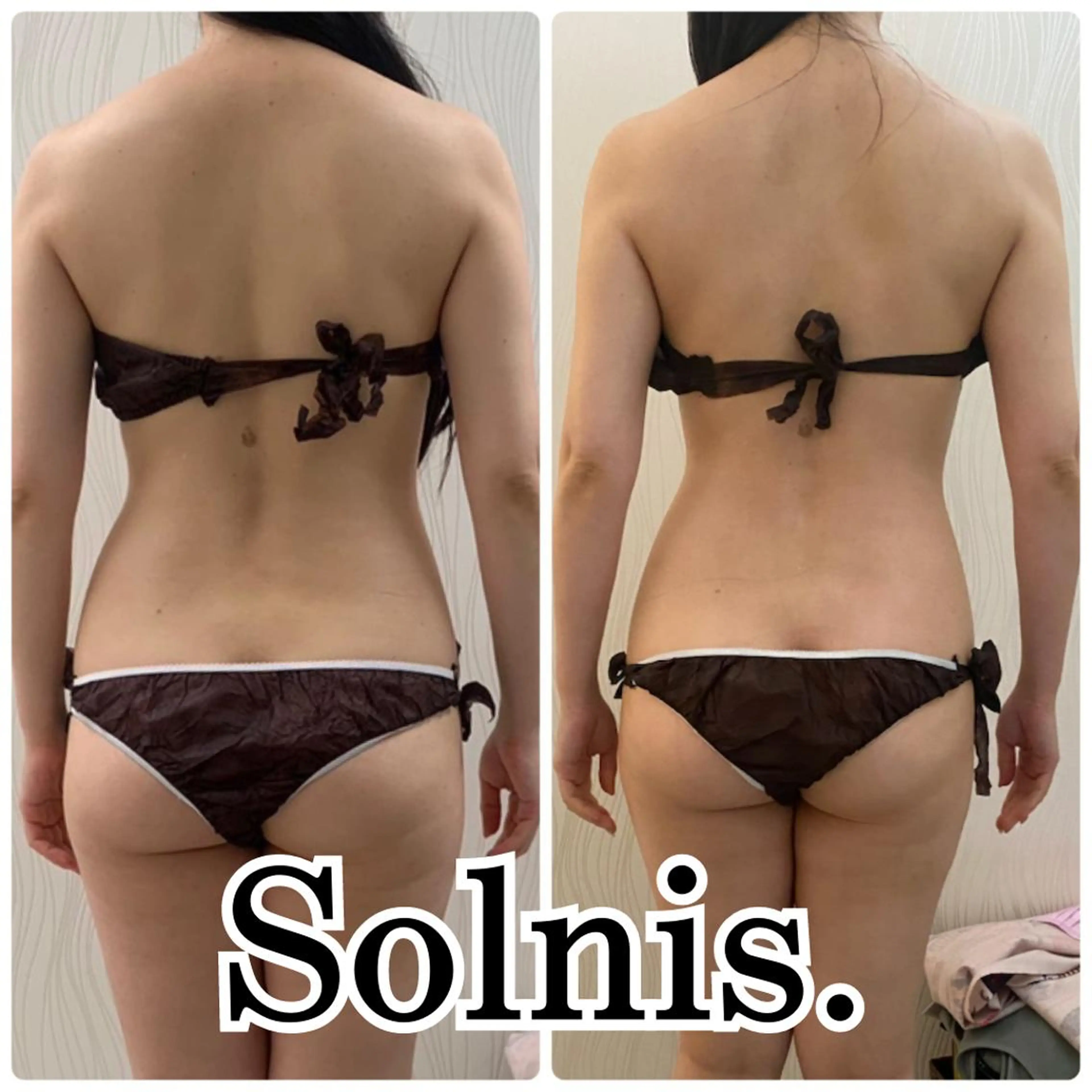 👑全身人気NO1👑ハイパーシェイプ🩷メスを使わない脂肪吸引🩷徹底全身しっかり施術90分‼️の写真