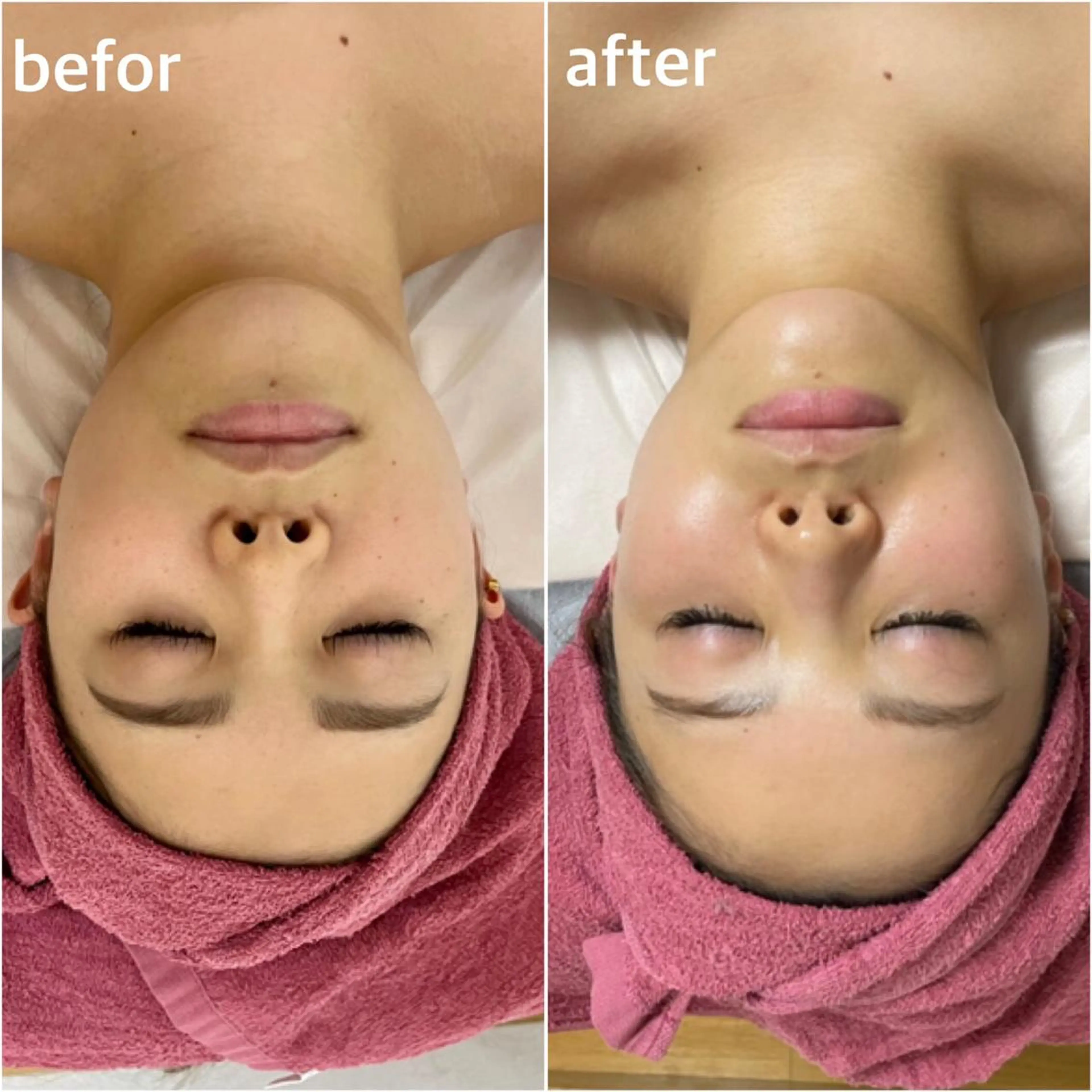 お肌のコラーゲン量UP✨光フェイシャル(クレンジング・泡パック込み)の写真