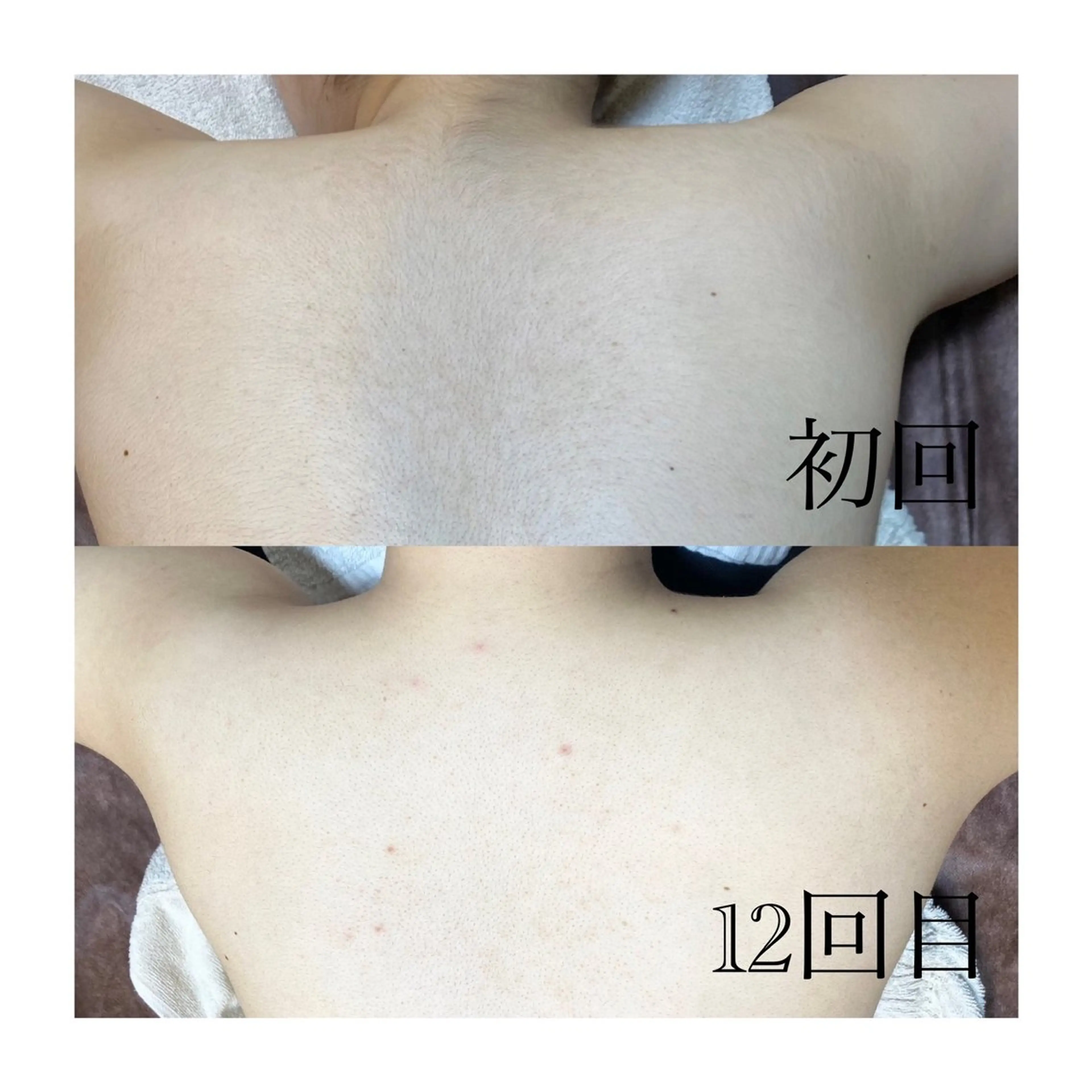 脱毛 温活beautyサロンNeroli所属・切らない脂肪吸引🔥 Neroliまりこのエステ・リラクイメージ