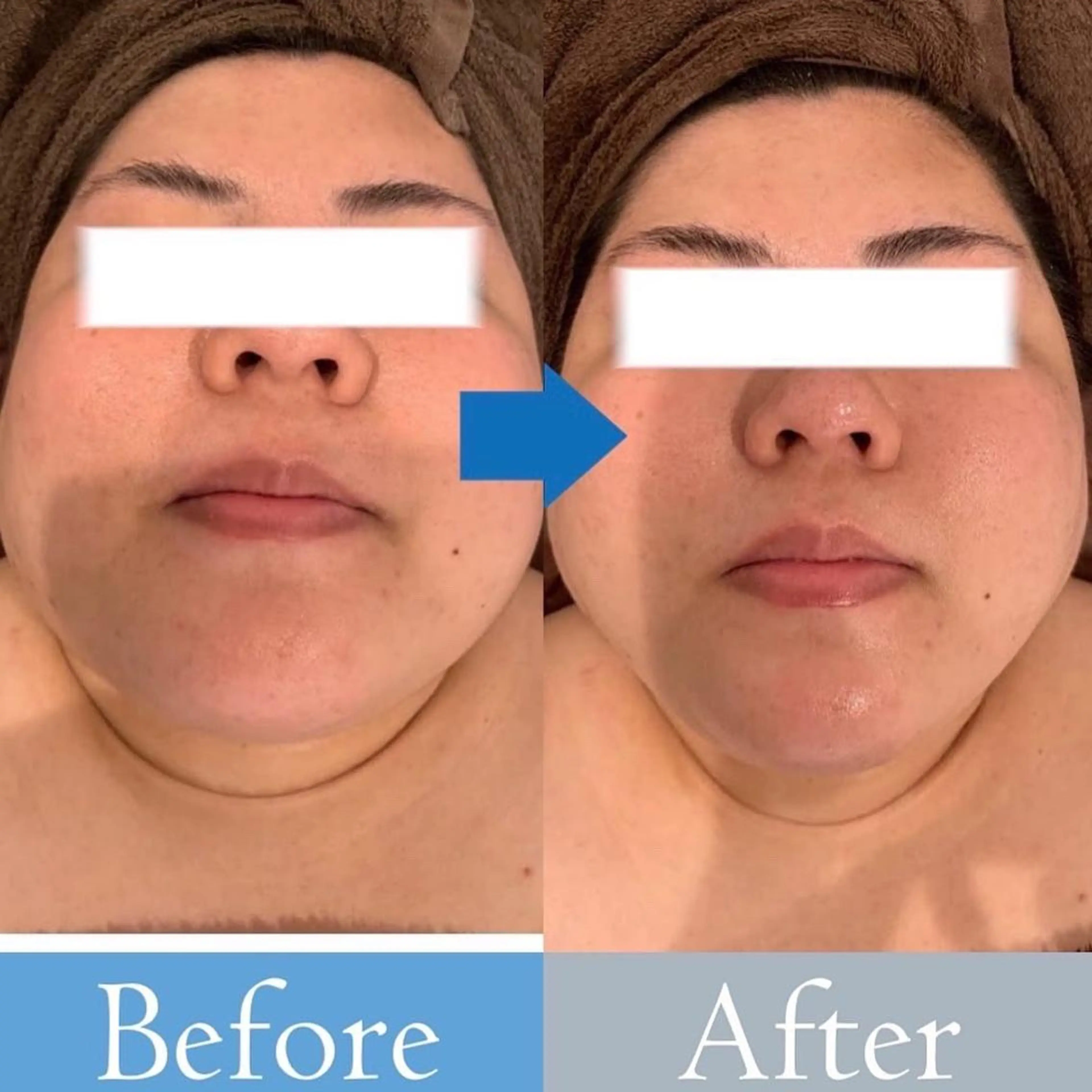 脱毛・ハイフ ・フェアリーのエステ・リラクイメージ