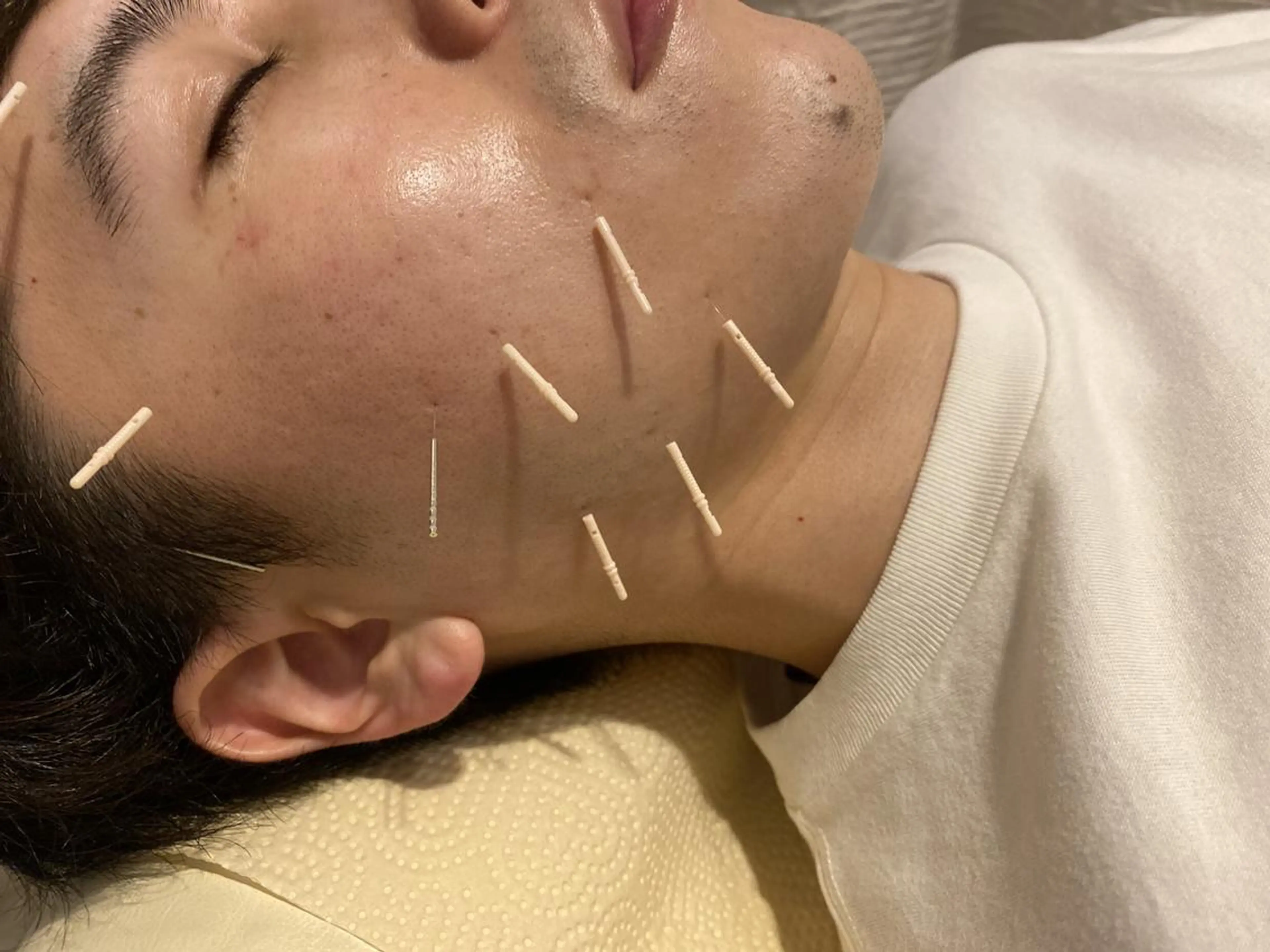 むくみたるみ専門☆ 美容鍼・小顔矯正のエステ・リラクイメージ