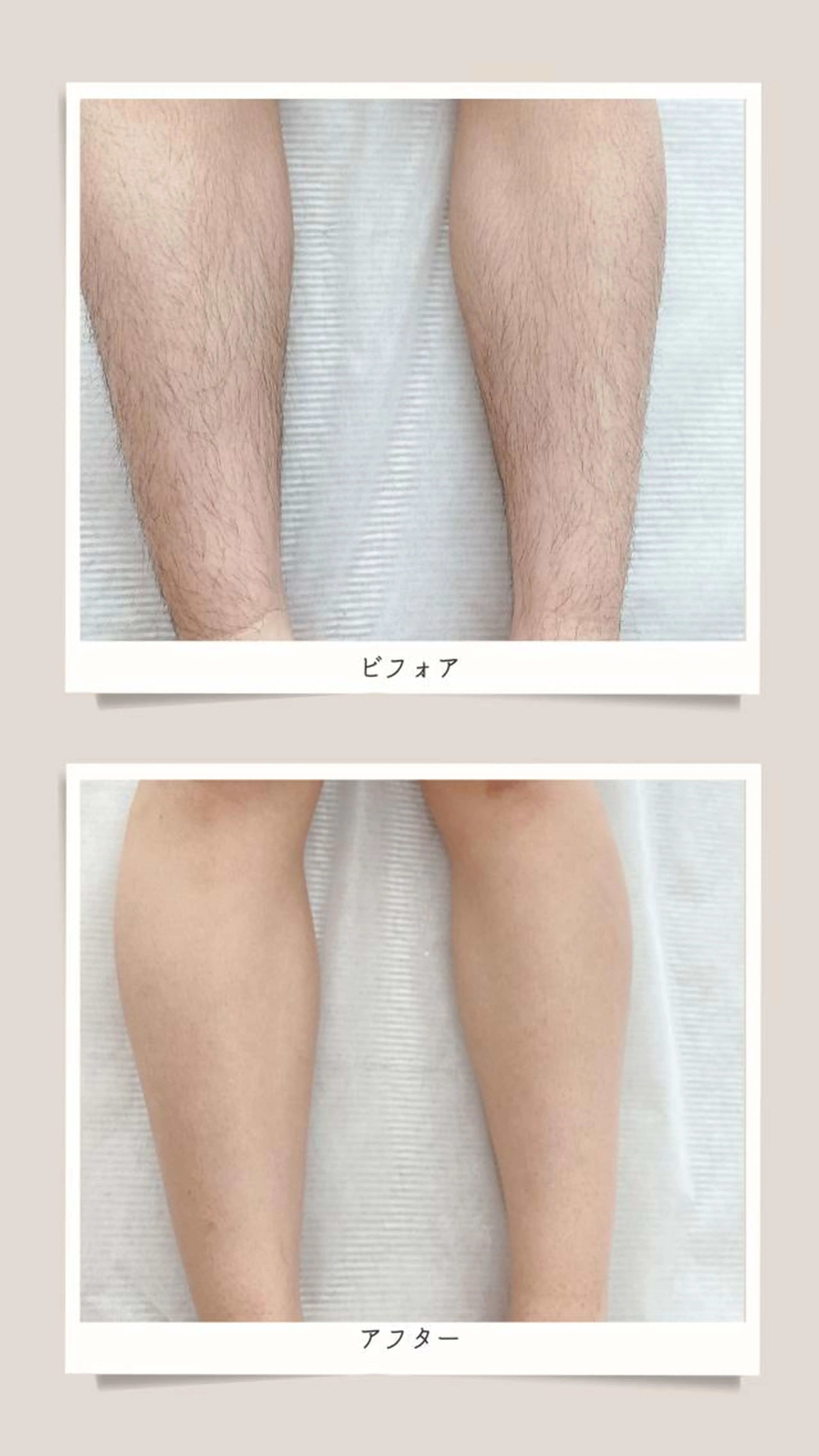 フルレッグ（ひざ下&ひざ上/両脚） ※自己処理なしでお越しください.の写真