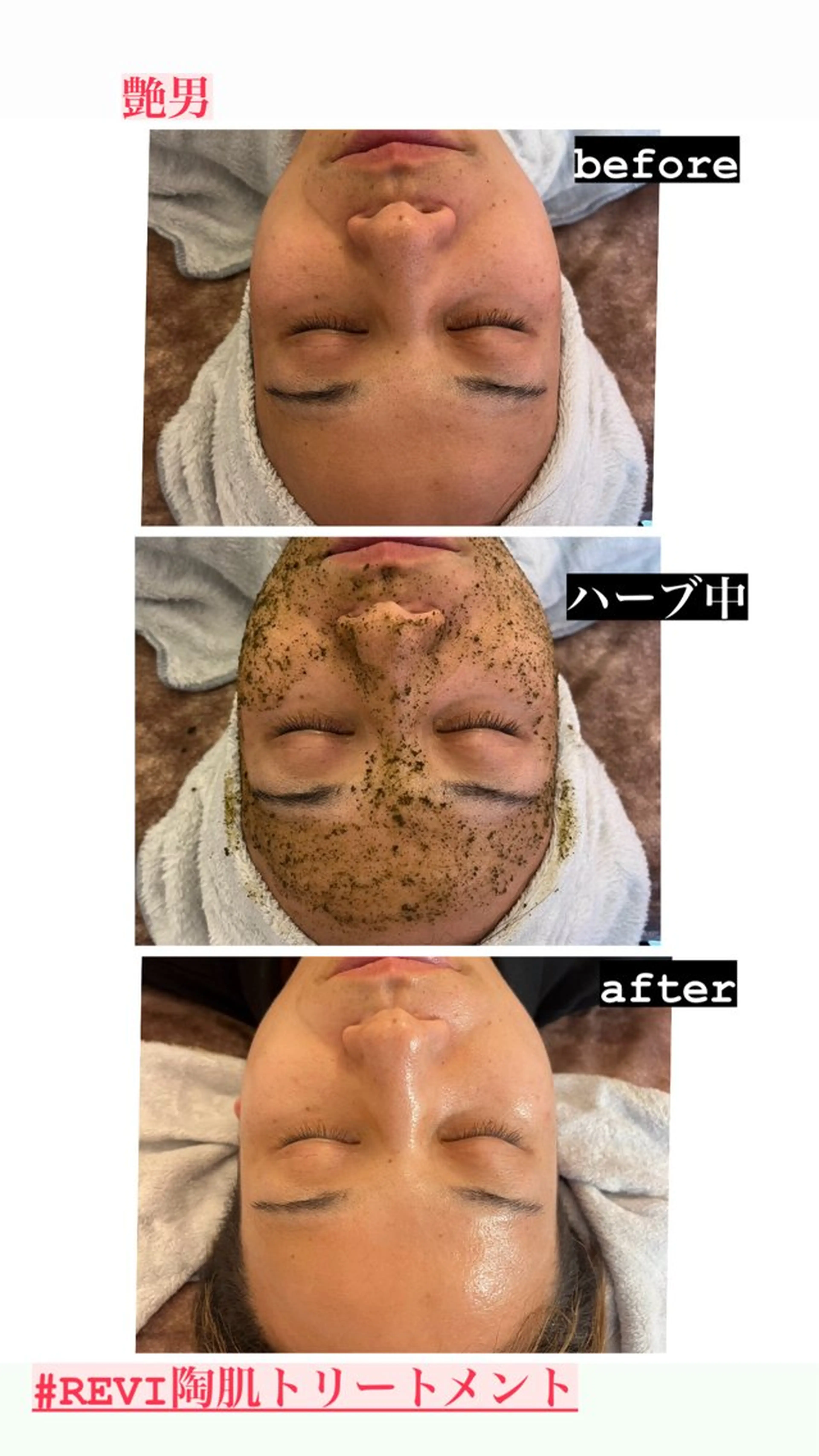 ハーブピーリング/韓国肌管理/フェイシャル/毛穴洗浄/眉毛/顔脱毛【糸脱毛専門】rev所属・ハーブピーリング🌹 毛穴洗浄❤️眉waxのエステ・リラクイメージ