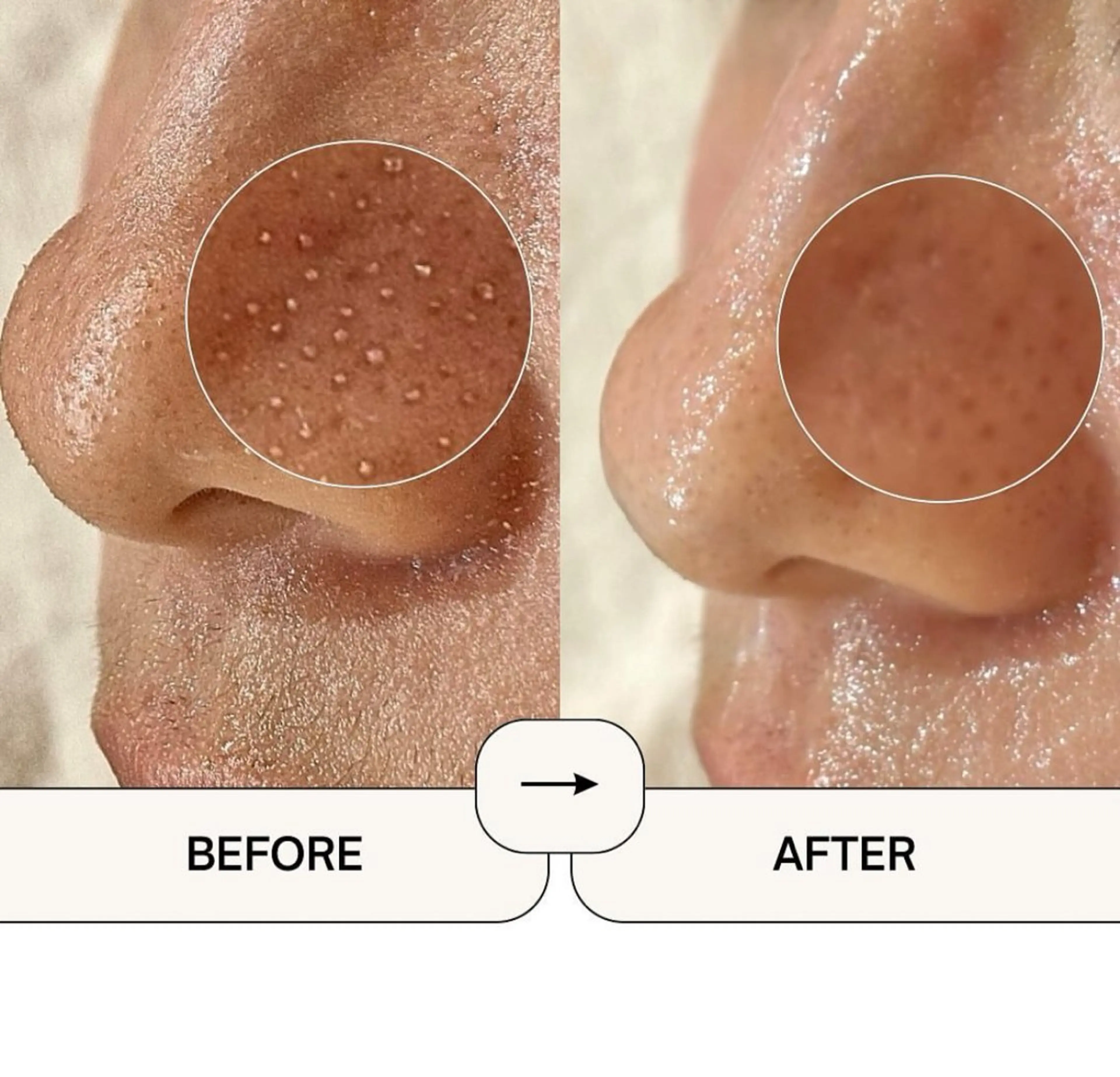 【1日3名限定】モニター価格🉐韓国式毛穴洗浄🫧✨メンズOK🙆‍♂️黒ずみ/いちご鼻/角栓¥5,500➝¥3,400の写真