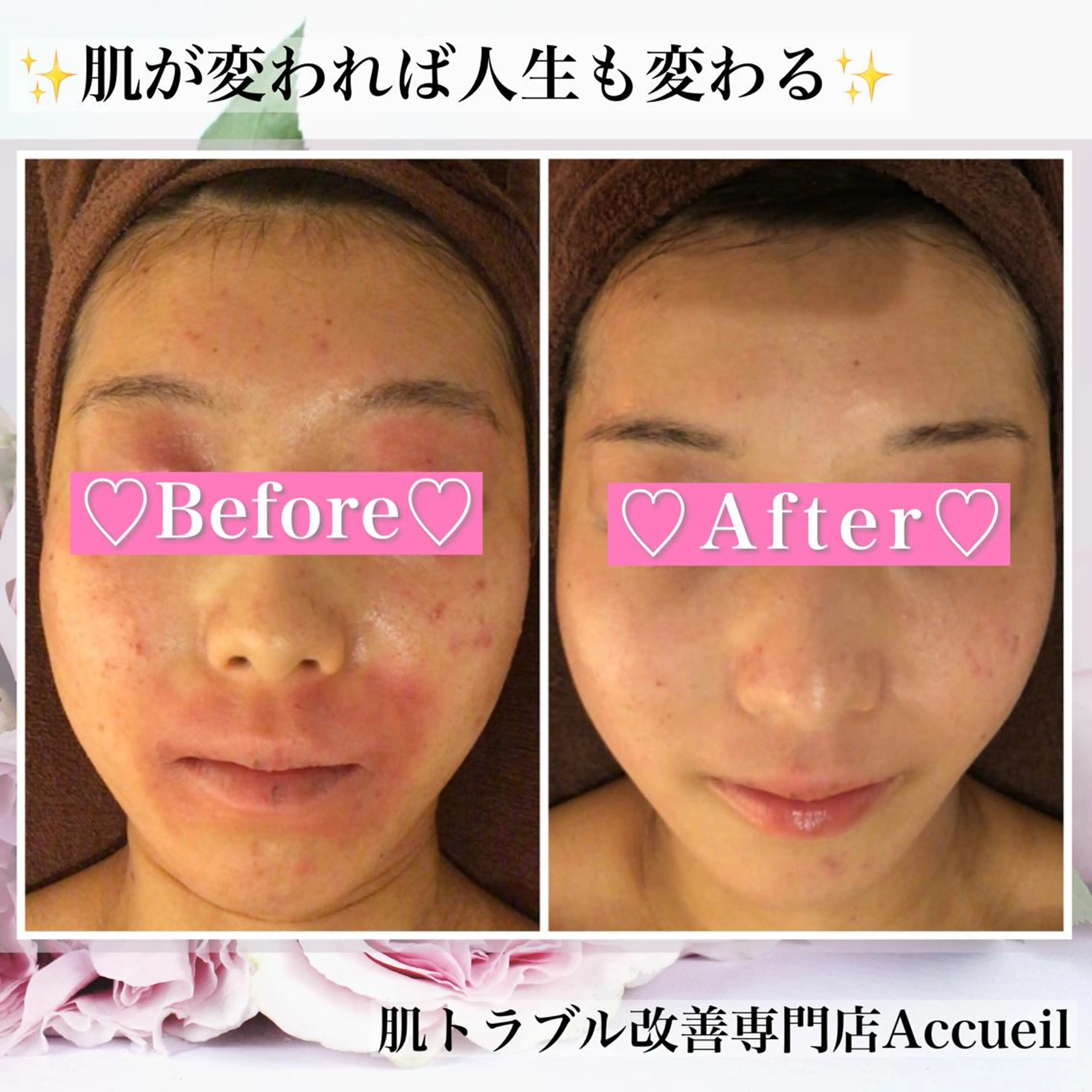 ミディアム カラー パーマ ヘアアレンジ メンズ キッズ ネイル マツエク・マツパ アイブロウ エステ リラク ニキビ・肌質改善専門 ♡人生が変わるサロンのエステ・リラクイメージ