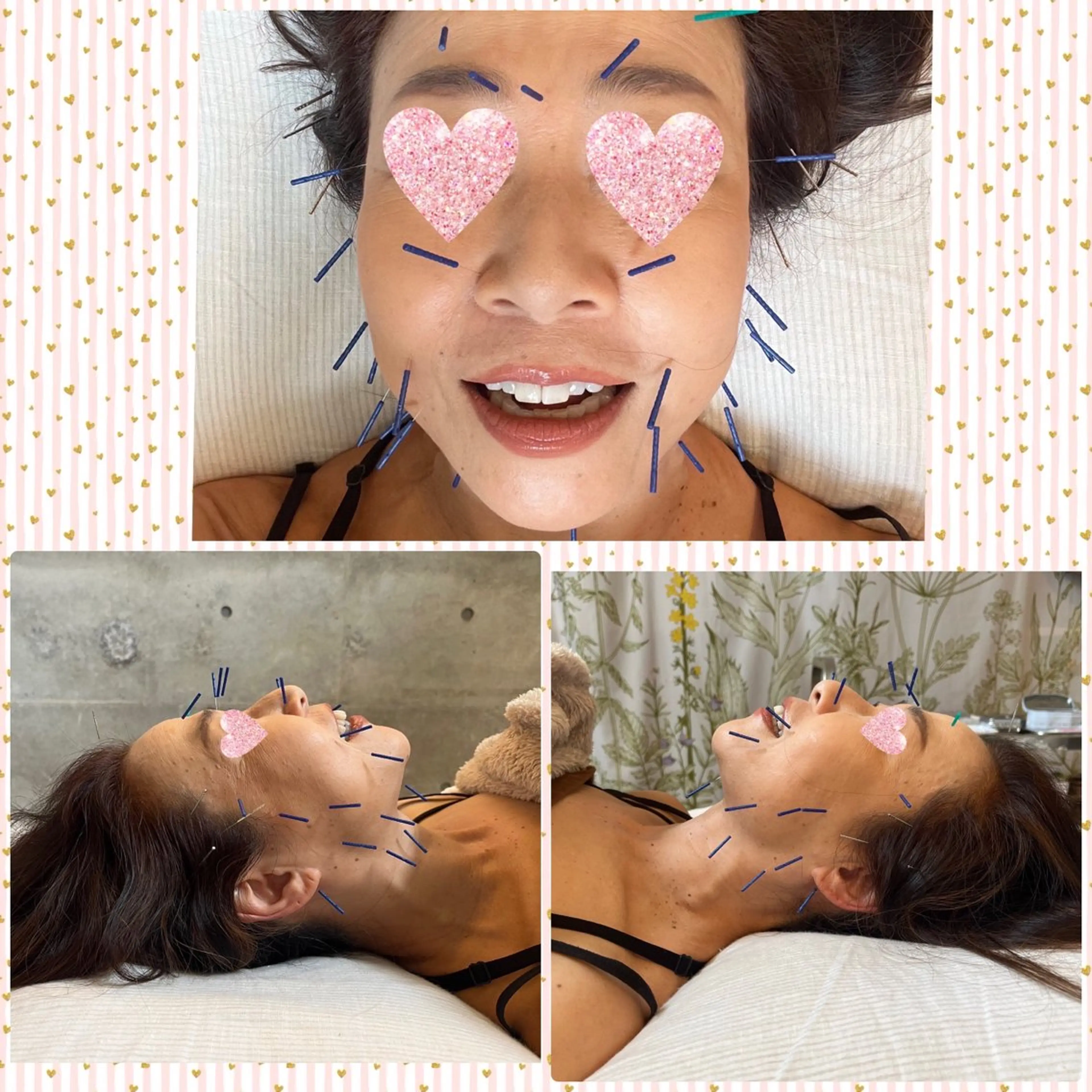 さくらんぼ鍼灸院所属・美容鍼&温活・免活 さくらんぼ鍼灸院のエステ・リラクイメージ