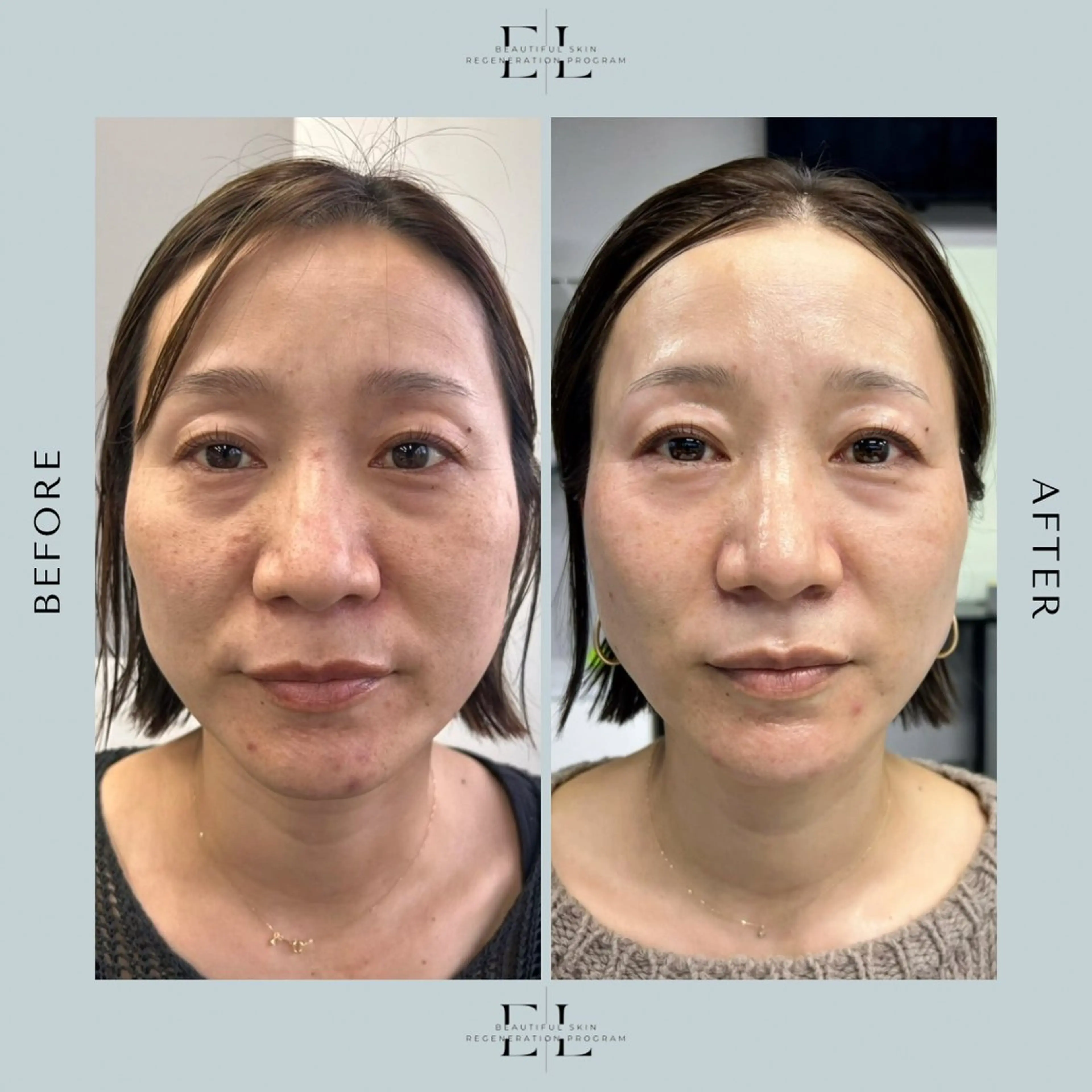 姫路初【速効性◎】究極のエイジングケア/Exolift  エクソリフトの写真