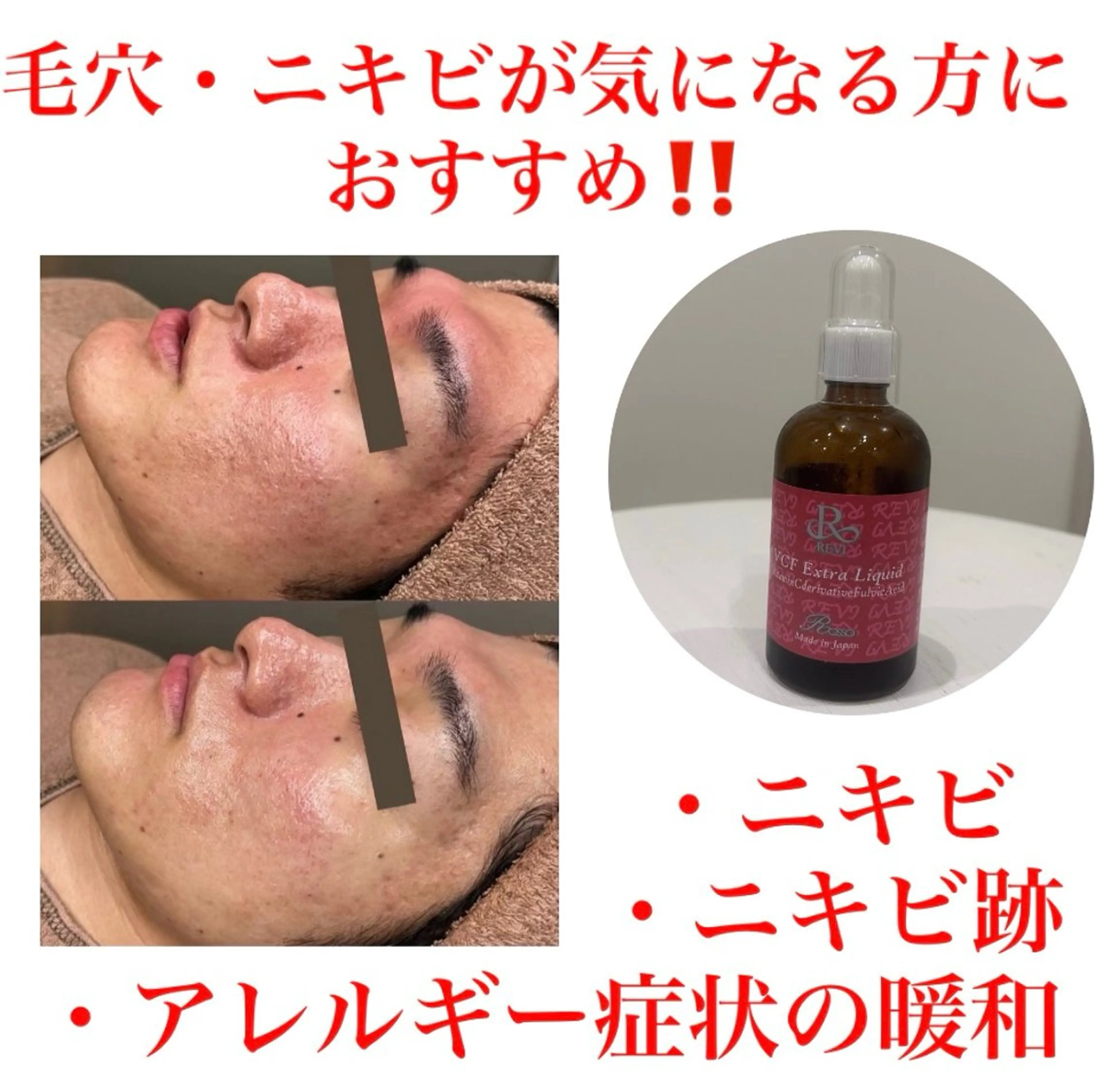 【毛穴・ニキビが気になる方にオススメ！】REVIハーブピーリング＋VCF¥14300の写真