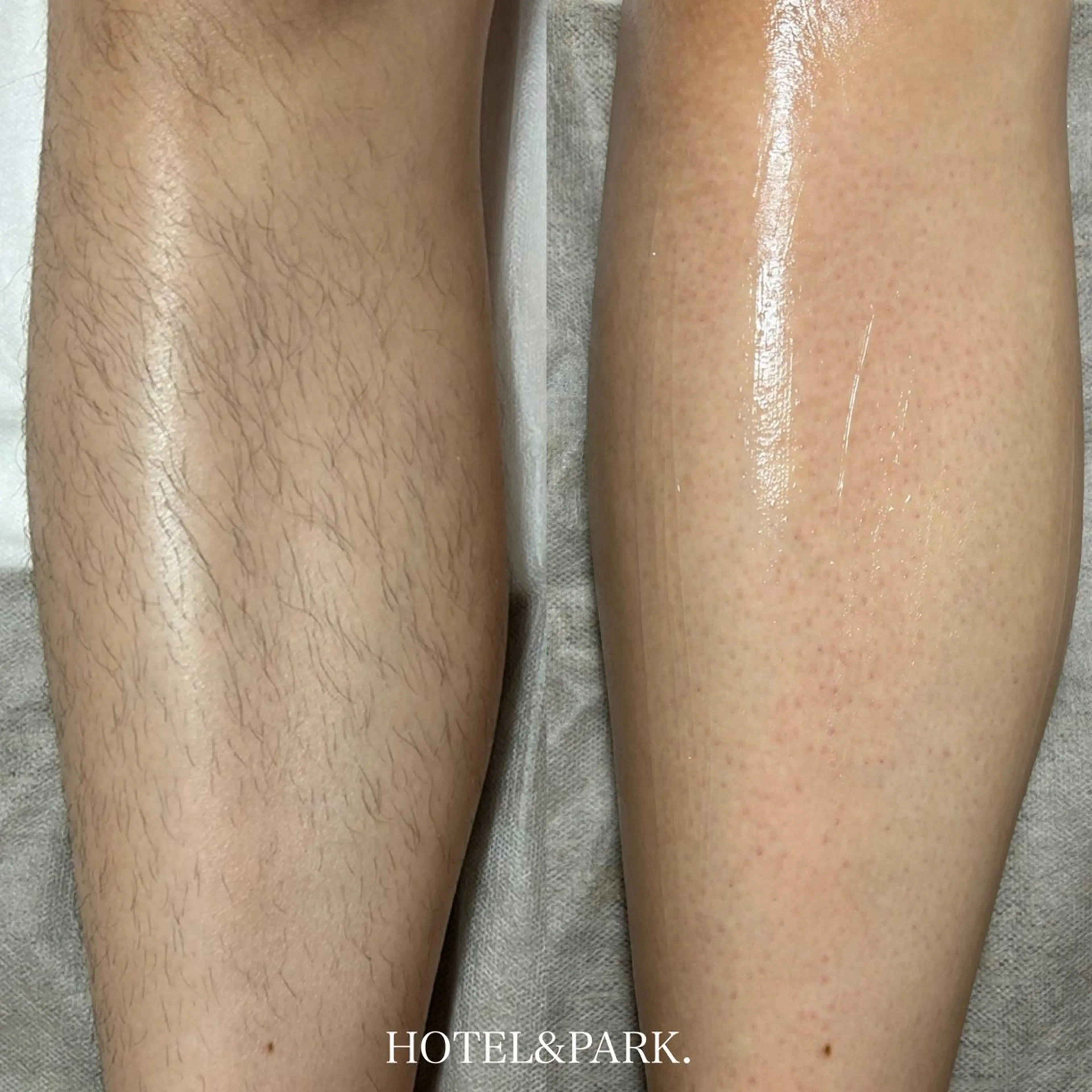 脱毛 HOTEL&PARK .Moeワックス脱毛のエステ・リラクイメージ