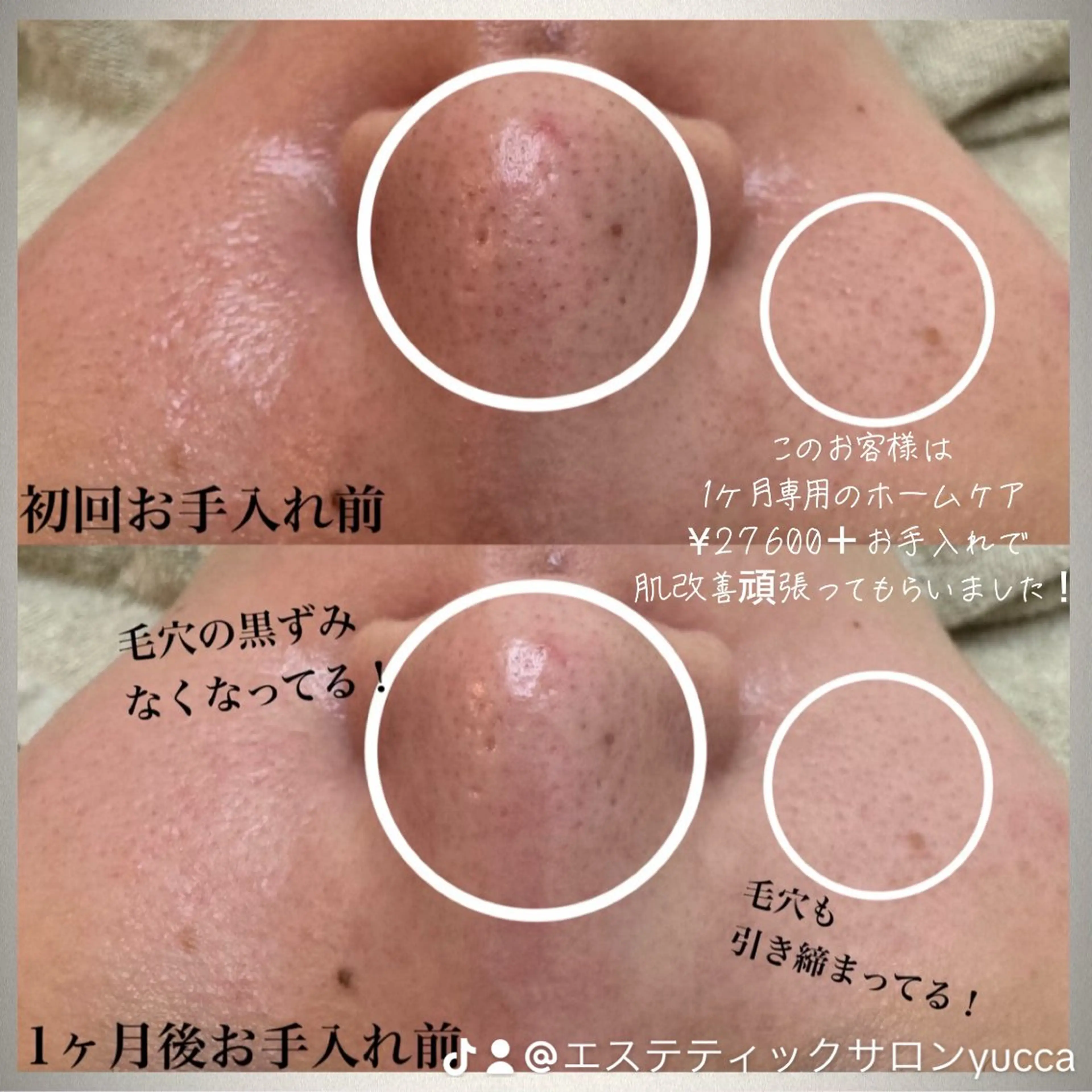 【人気No. 1】集中毛穴ケア 陶器肌・ノーファンデフェイシャル90分¥16500→7500の写真