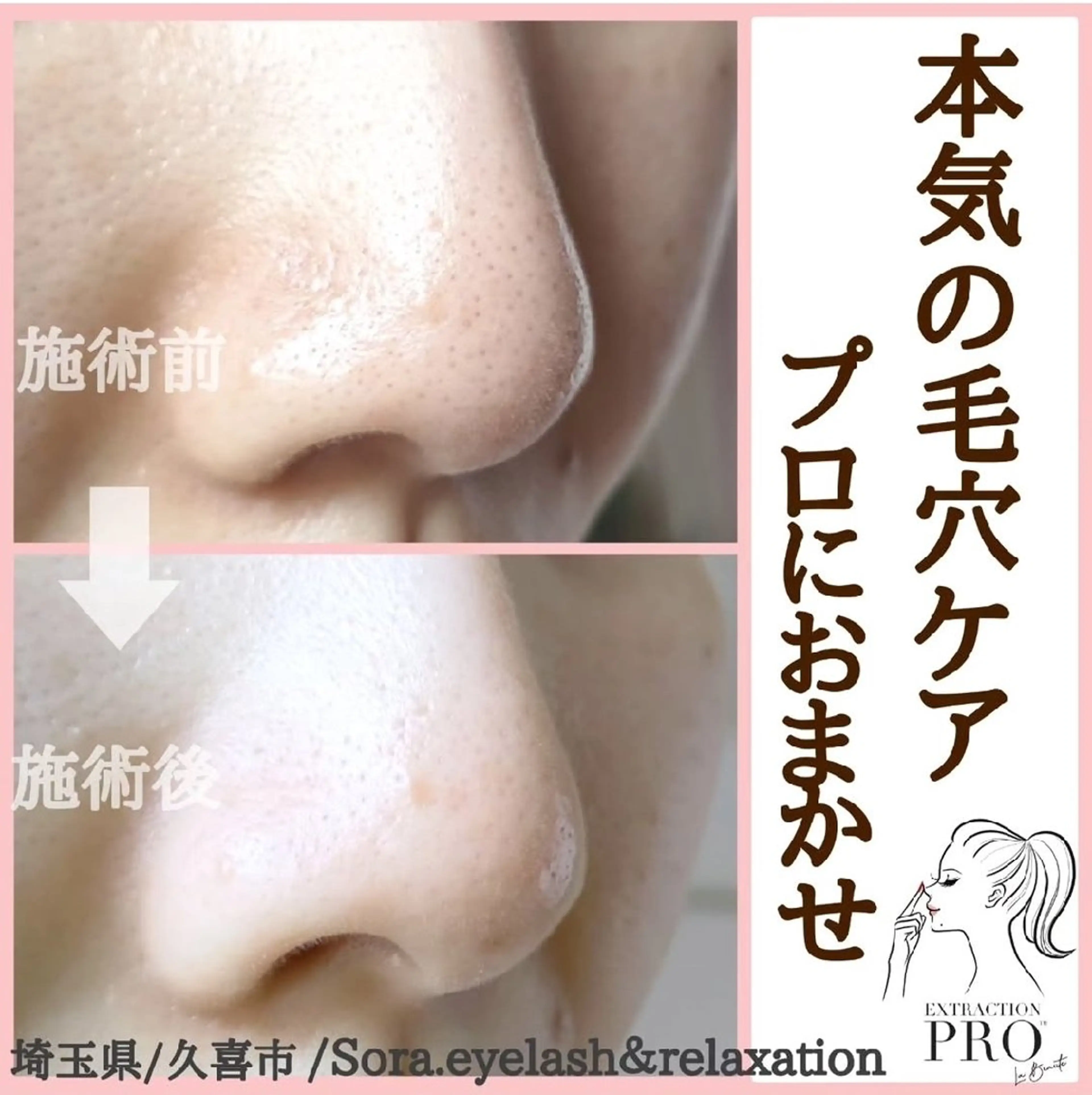 毛穴洗浄&リフトUPエステ  ￥6480⇒￥5480の写真