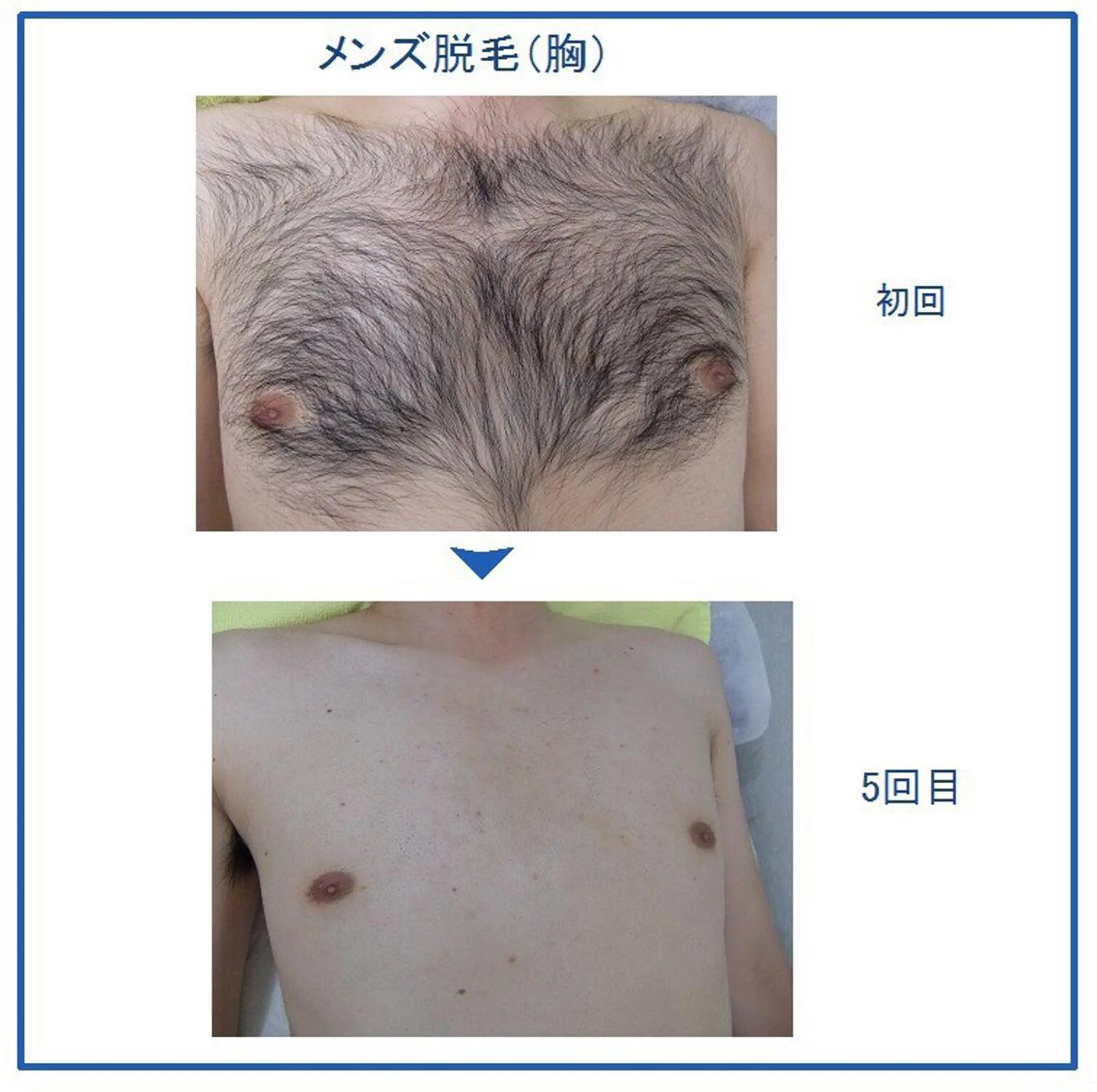 平日限定！定価7500円のところmen'sヒゲ脱毛3パーツ1900円の写真