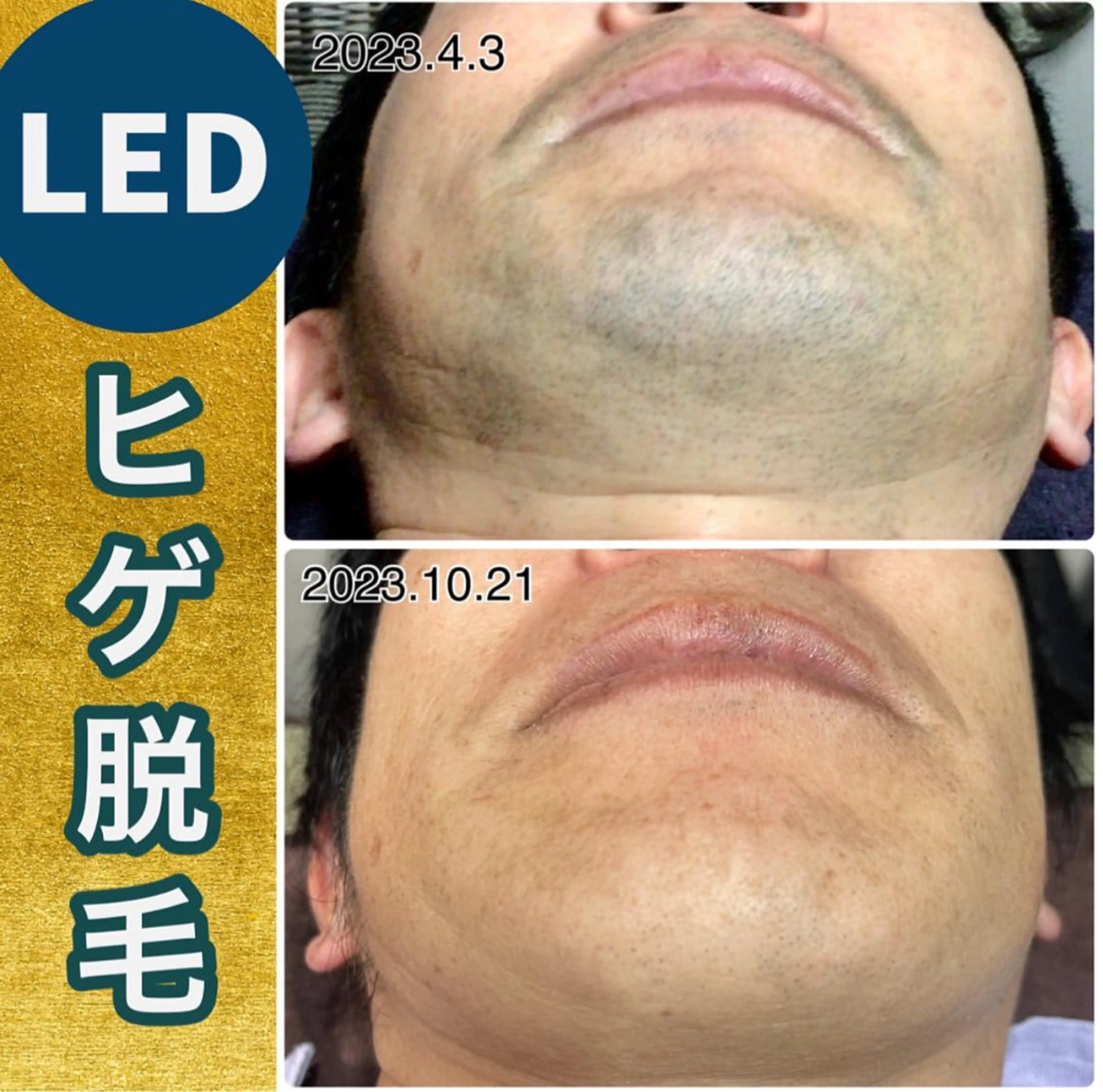 メンズ 脱毛 kozaki tomokoのエステ・リラクイメージ