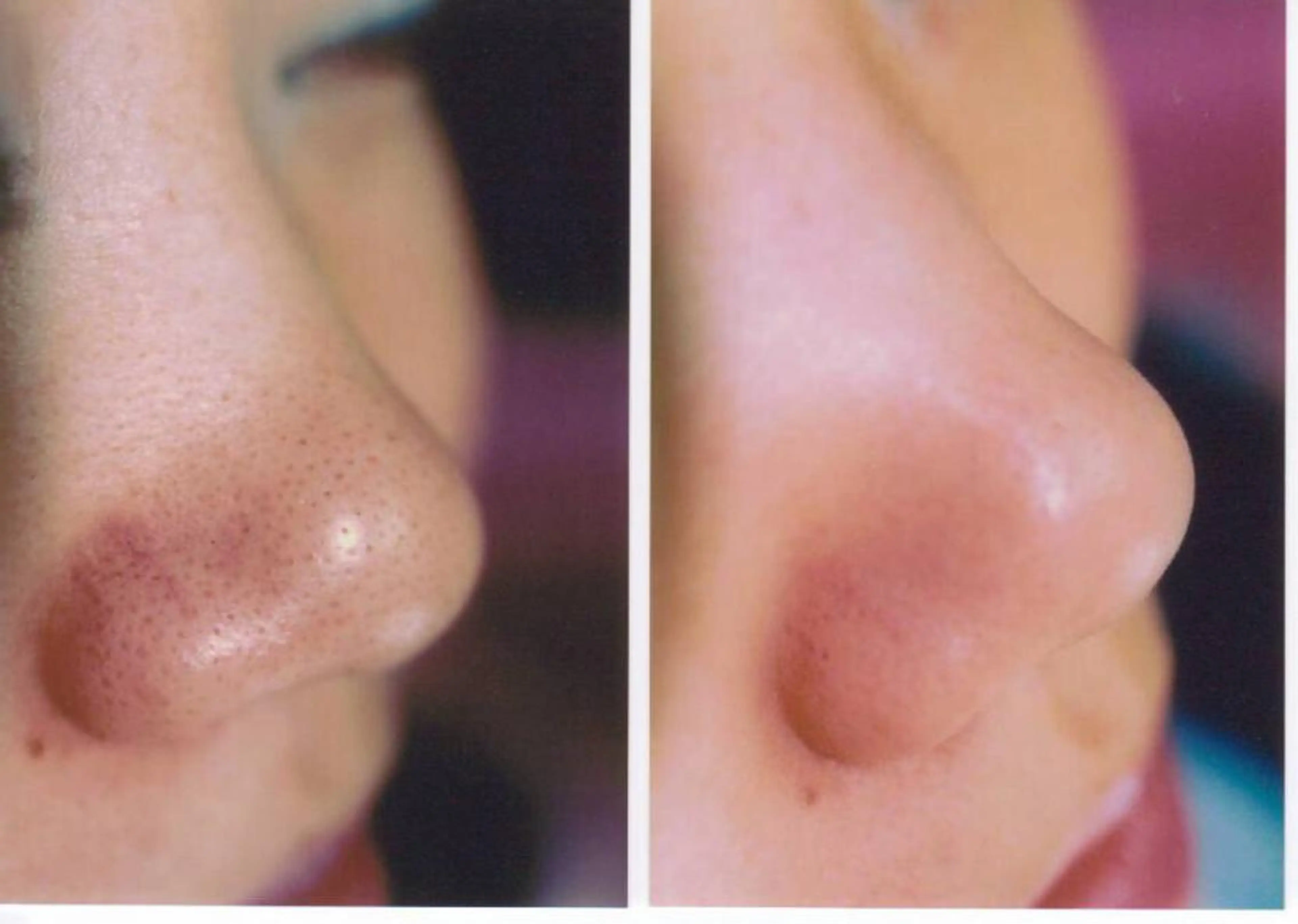 鼻の毛穴つるつるすべすべコースの写真