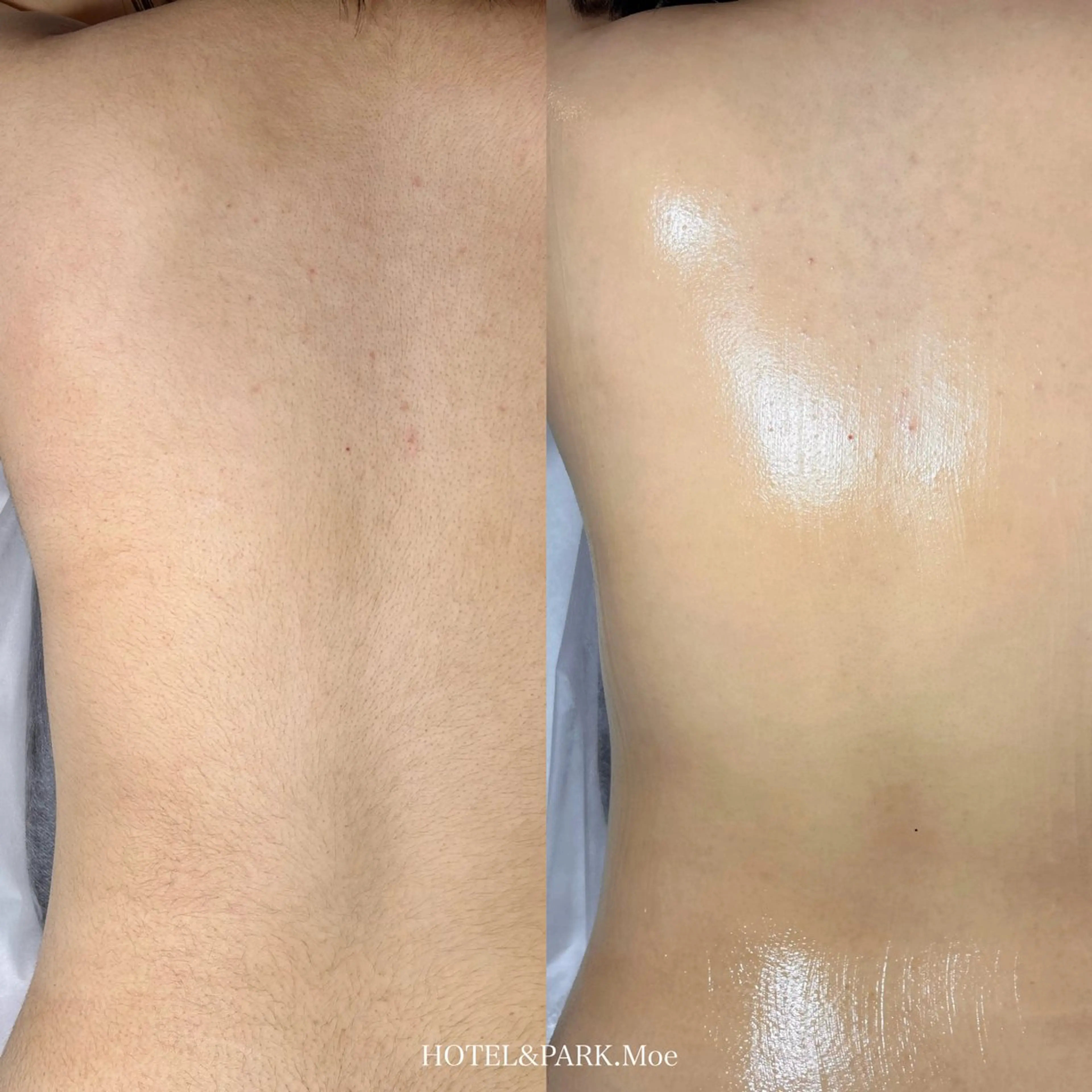 ☃️BIG SALE☃️【背中ALL*うなじ込ワックス脱毛】の写真