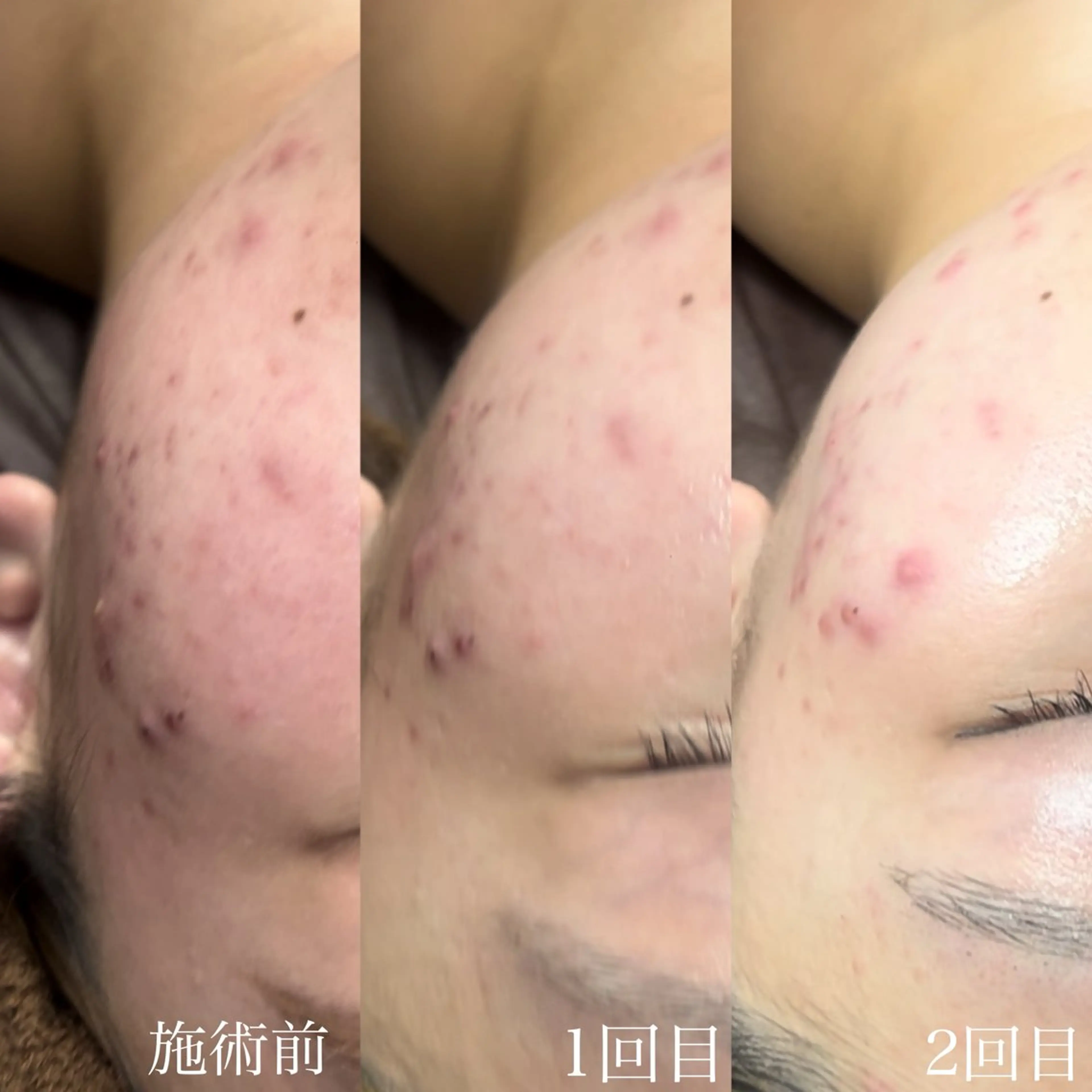 【9​〜​11月限定】肌質改善エステ💆🏻‍♀️ 次回も同額で施術可能♡ ¥4,500の写真