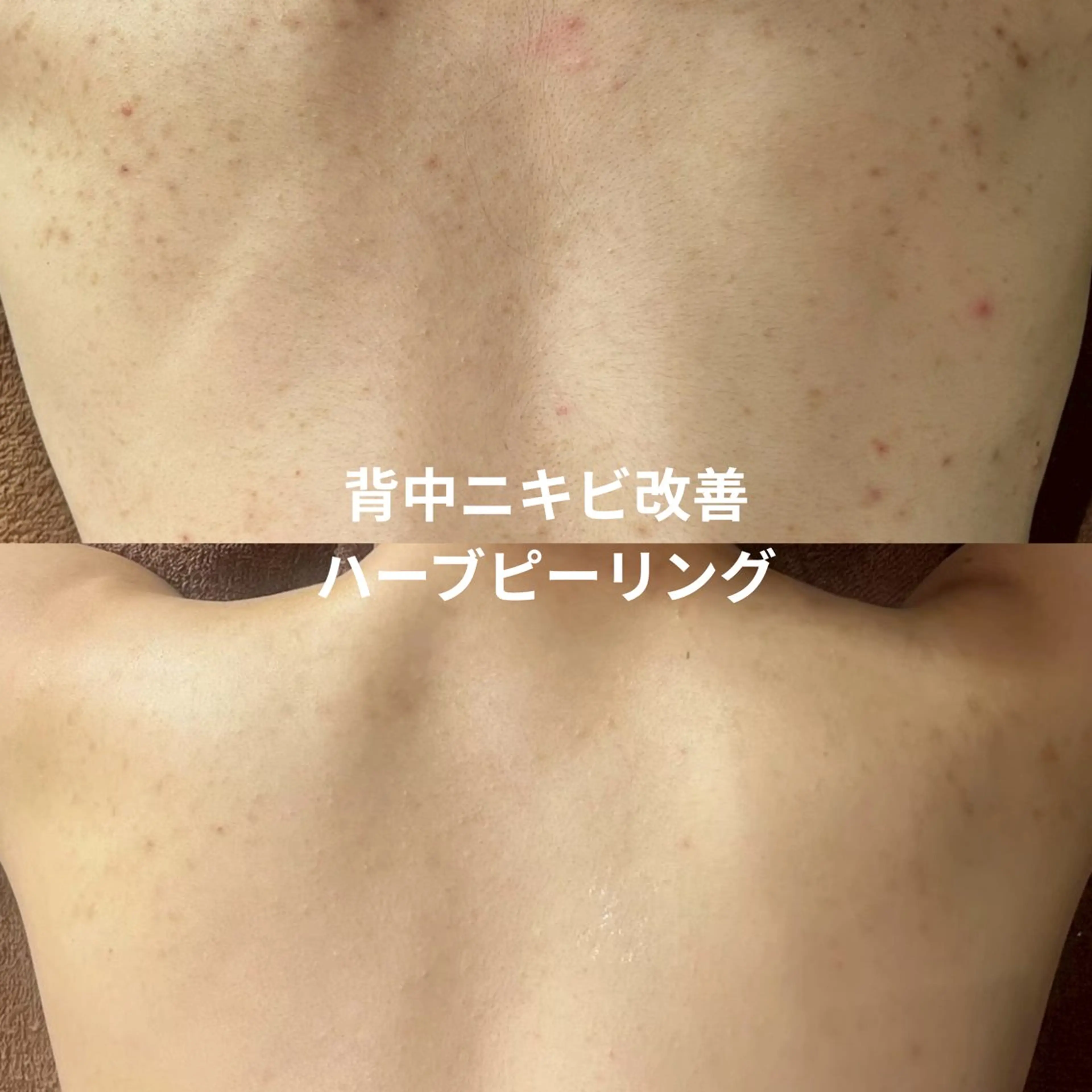 背中ハーブピーリング|ニキビ・赤み・ざらつき集中ケアの写真