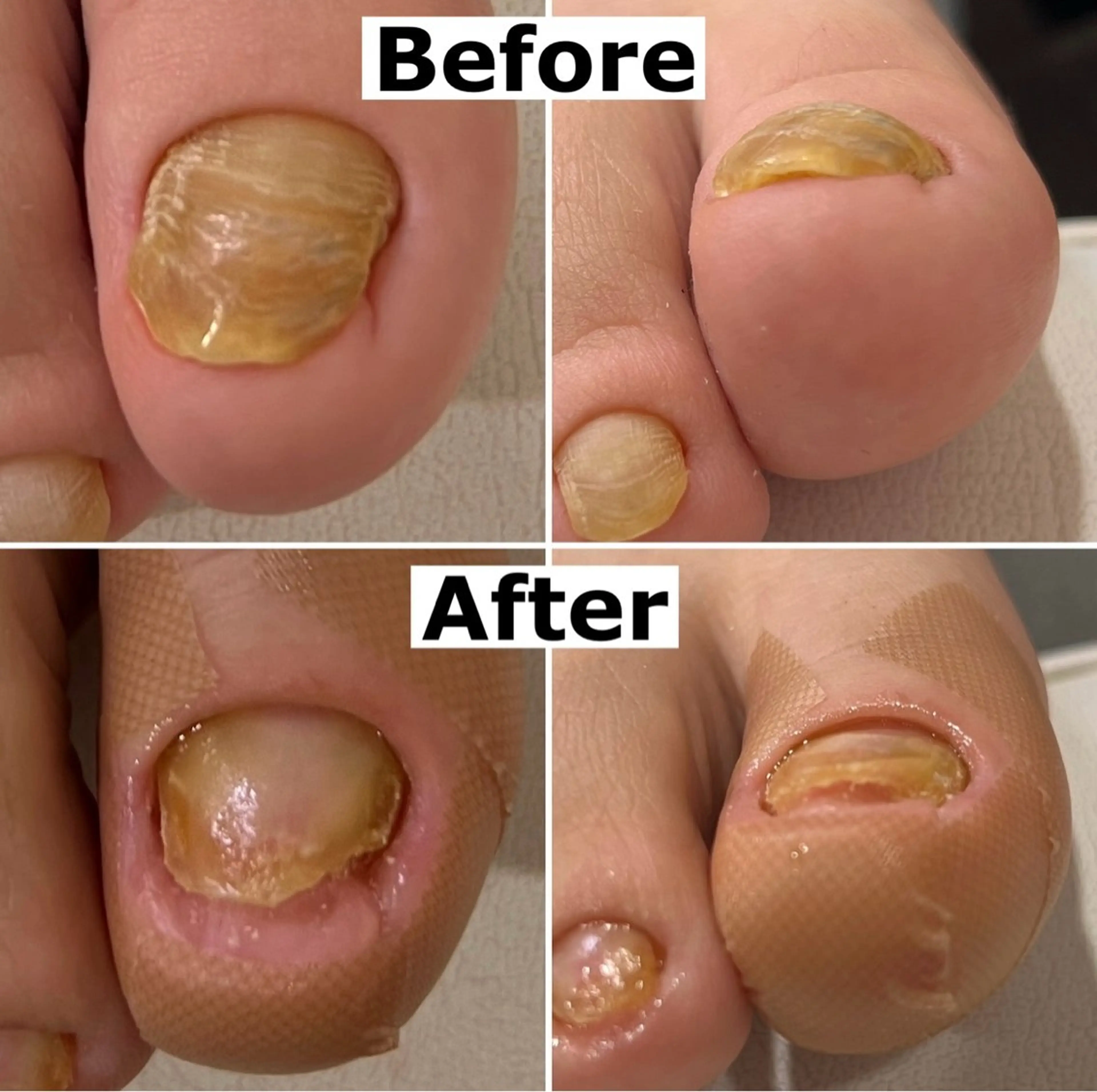 Mellow nail所属・巻爪無料モデル募集 ✨🦶MEGUMIのネイルデザイン