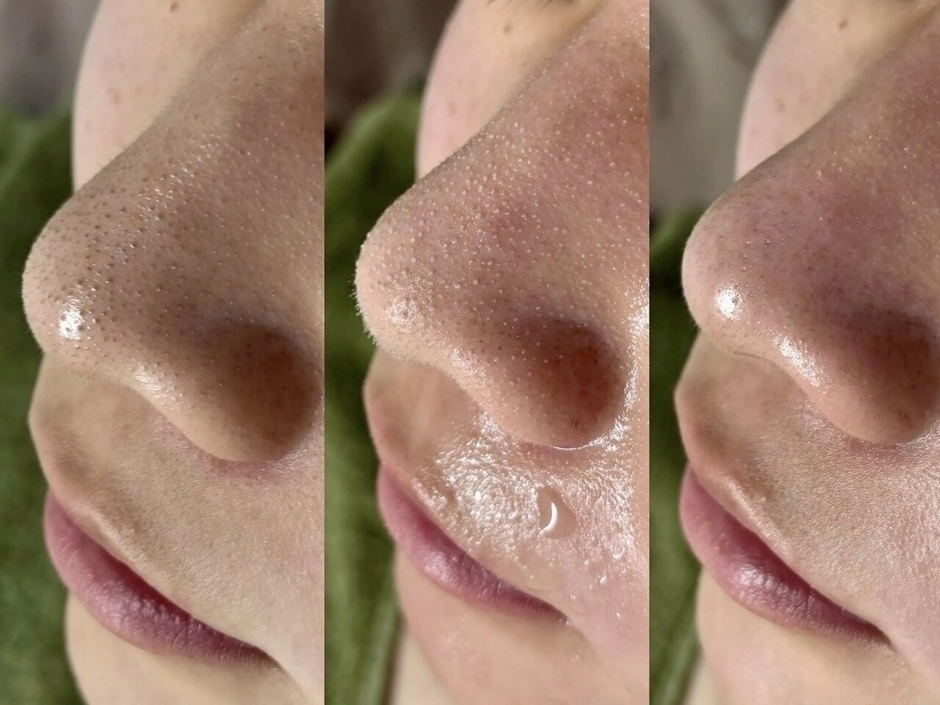 12/27まで鼻,顎,眉間の気になる部分の角栓,黒ずみ除去【溶ける毛穴吸引＆洗浄】￥5,980→￥5,000の写真