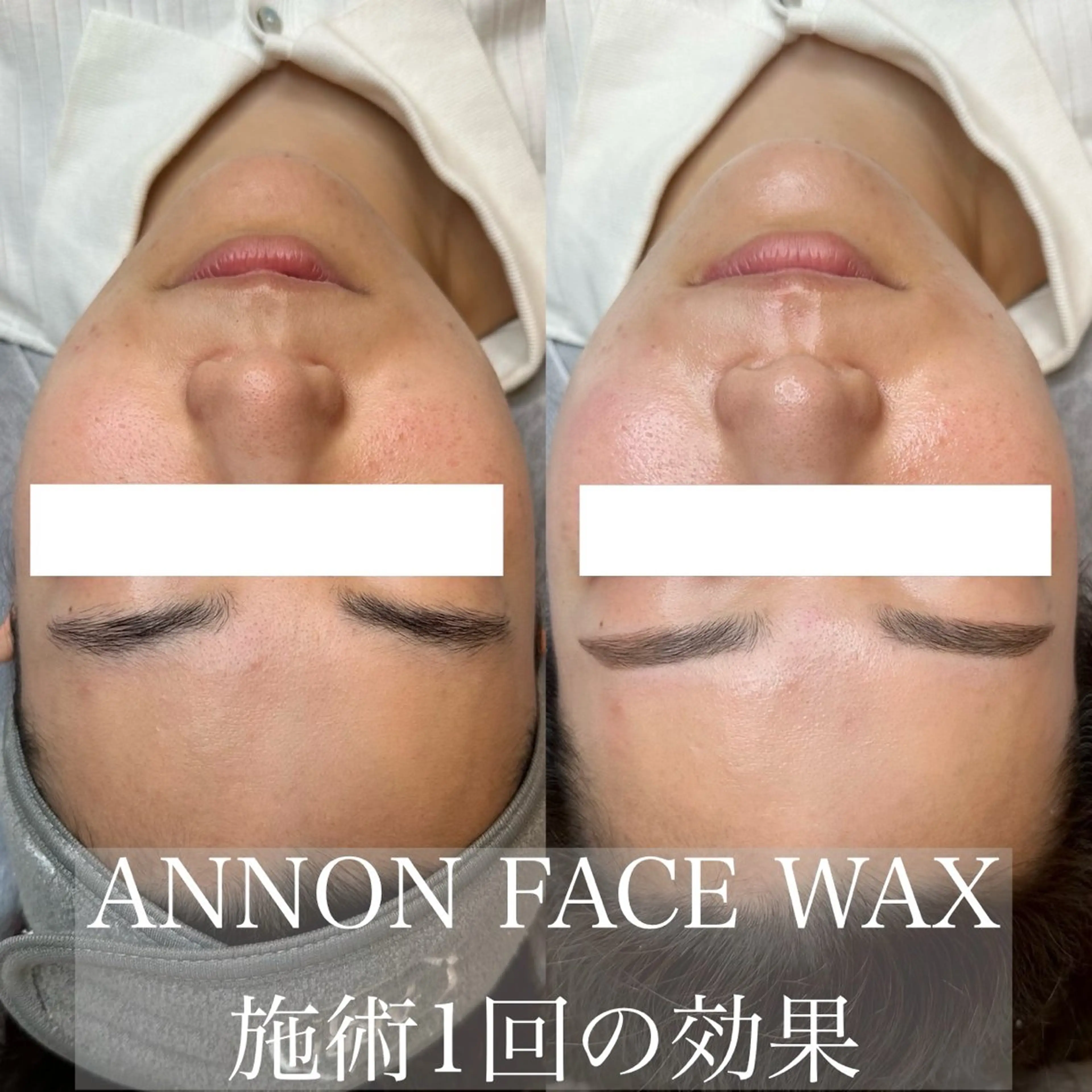 【地域最安値】美容好きはみんなやってる！フェイスワックス脱毛💆🏻‍♀️✨鎮静パック付き🌱🫧の写真