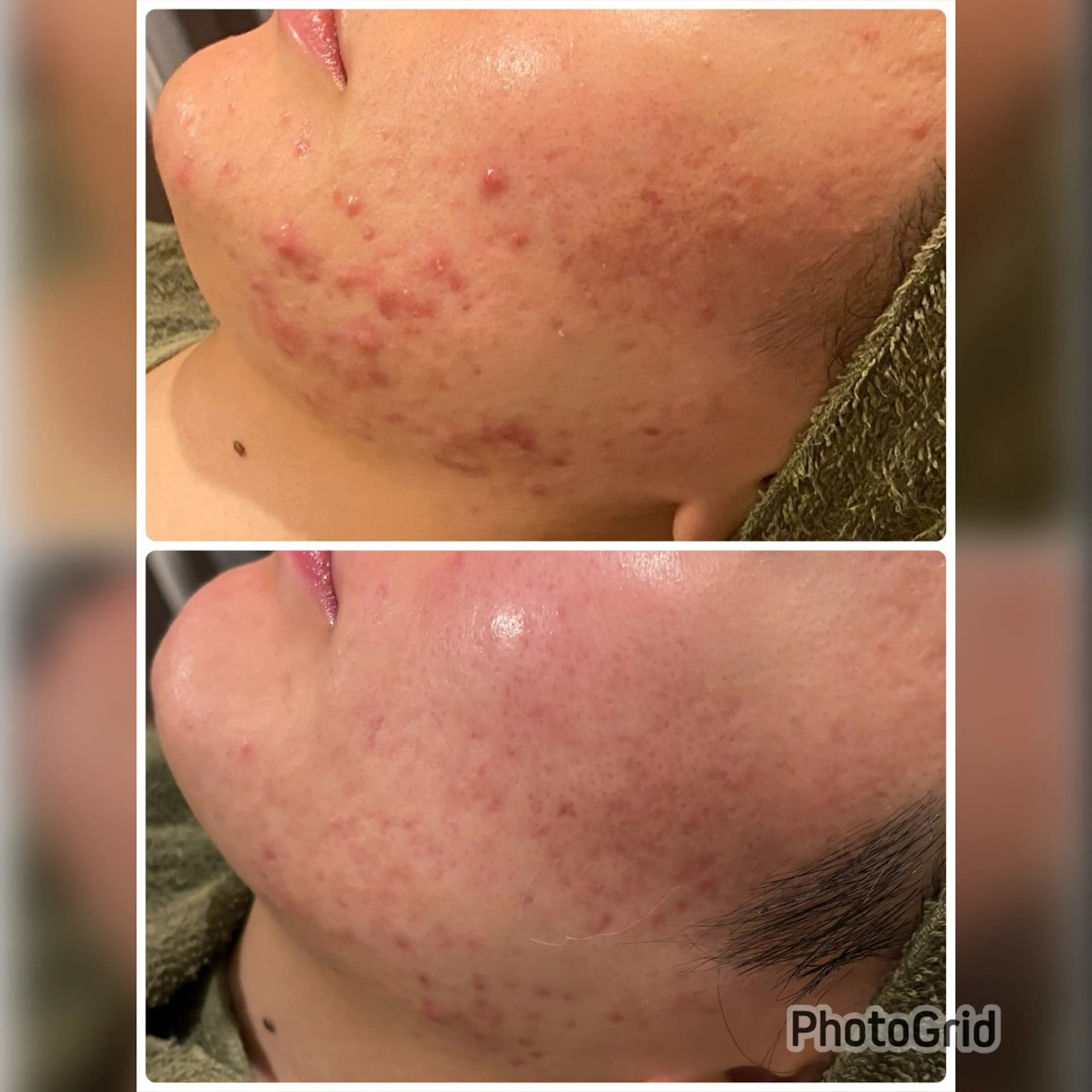 エステ 【リベルハーブピーリング認定店】敏感肌・美白脱毛専門店Dione立川店所属・Dione 立川店のエステ・リラクイメージ