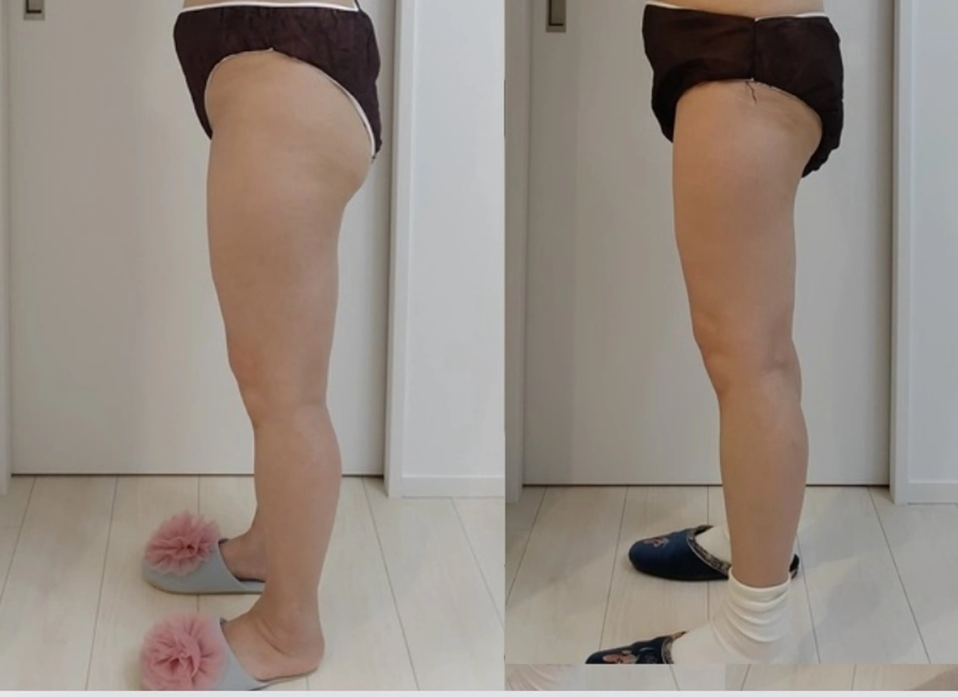 下半身パンパン必見！むくみセル撃退（太もも・ふくらはぎ・お尻）3箇所お得セットの写真