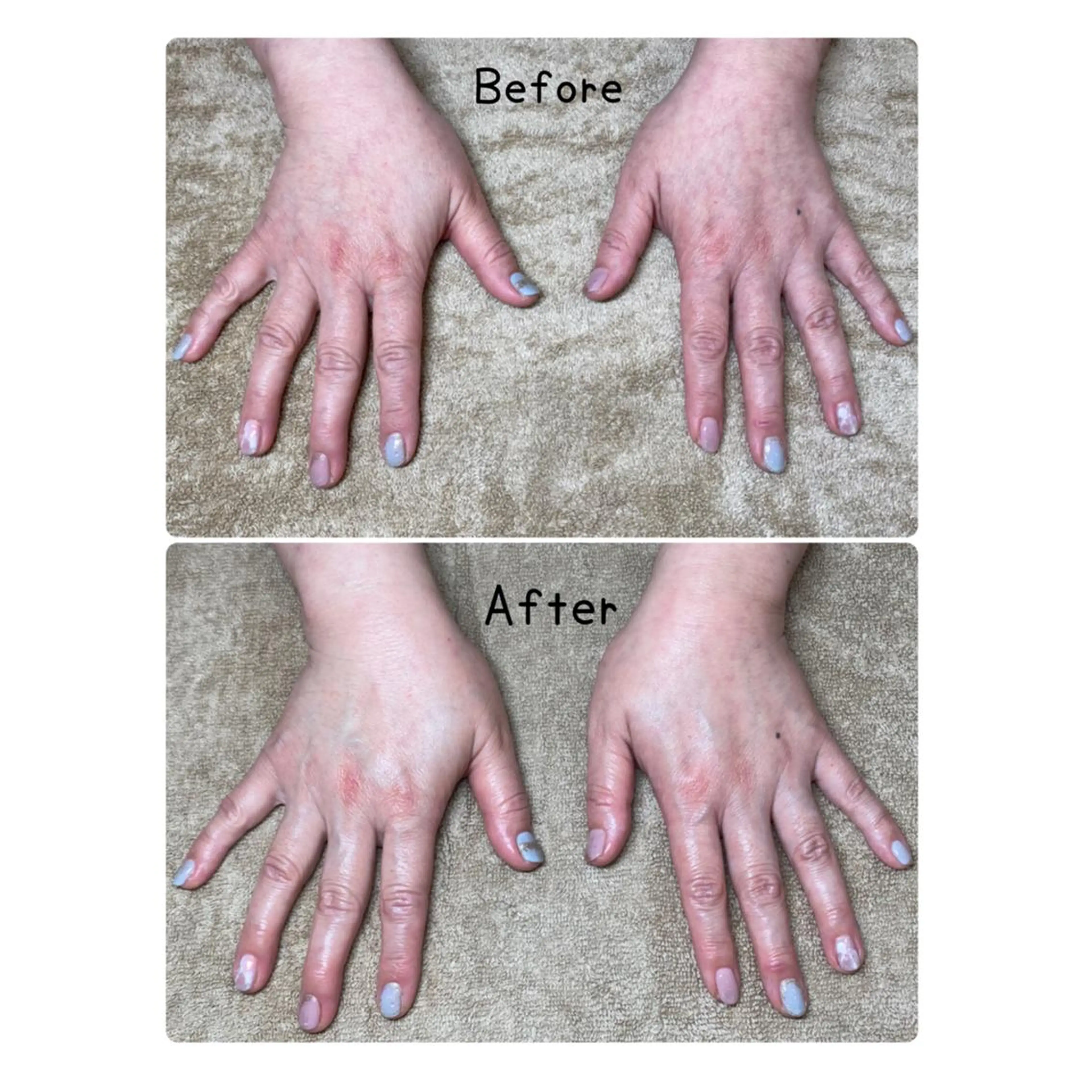 ハンドスパ🌺肘下から指先まで、内側からふっくらさせ、きめの細かい手肌に大変身❣️の写真
