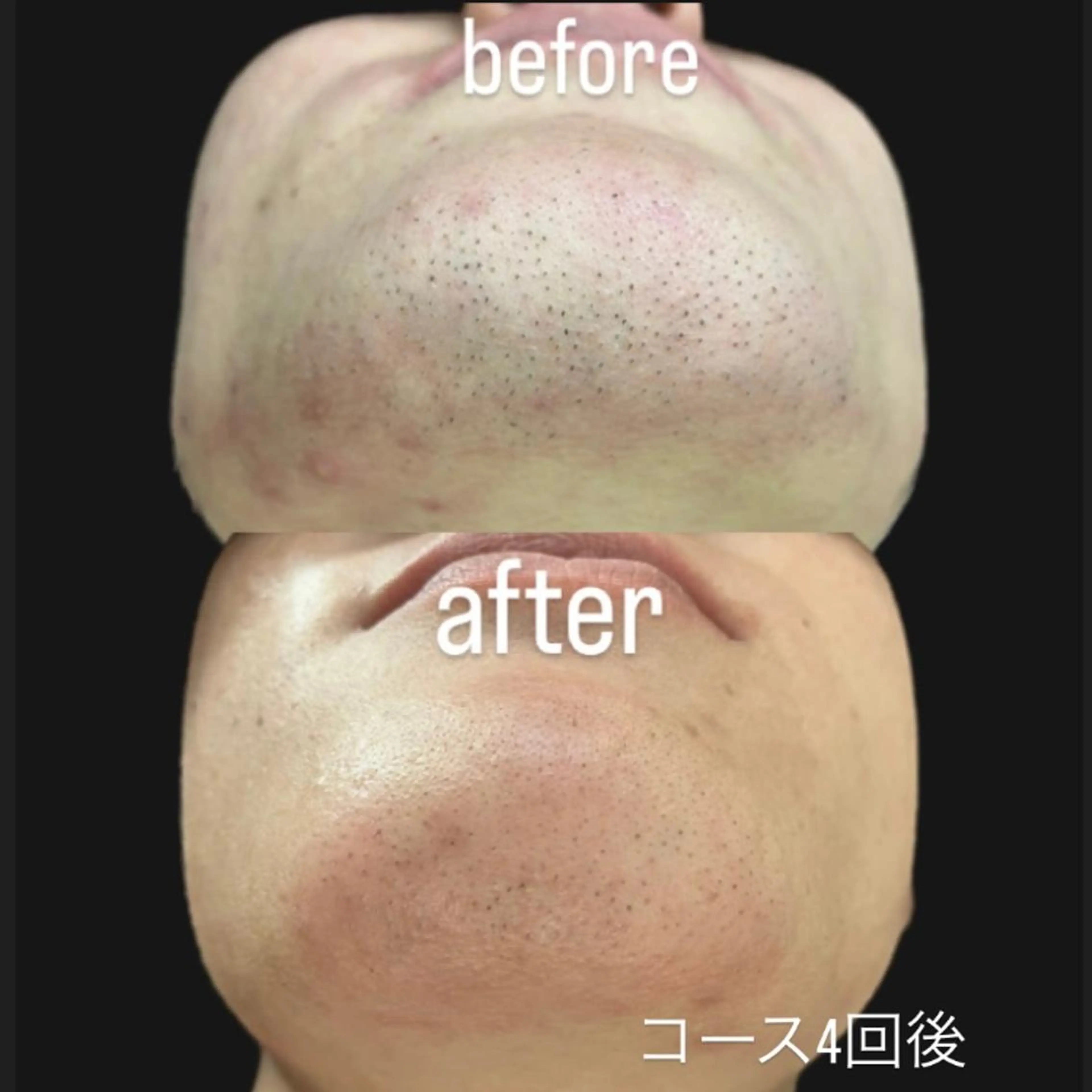 メンズ🩵【ヒゲ脱毛】痛み最小限✨の写真