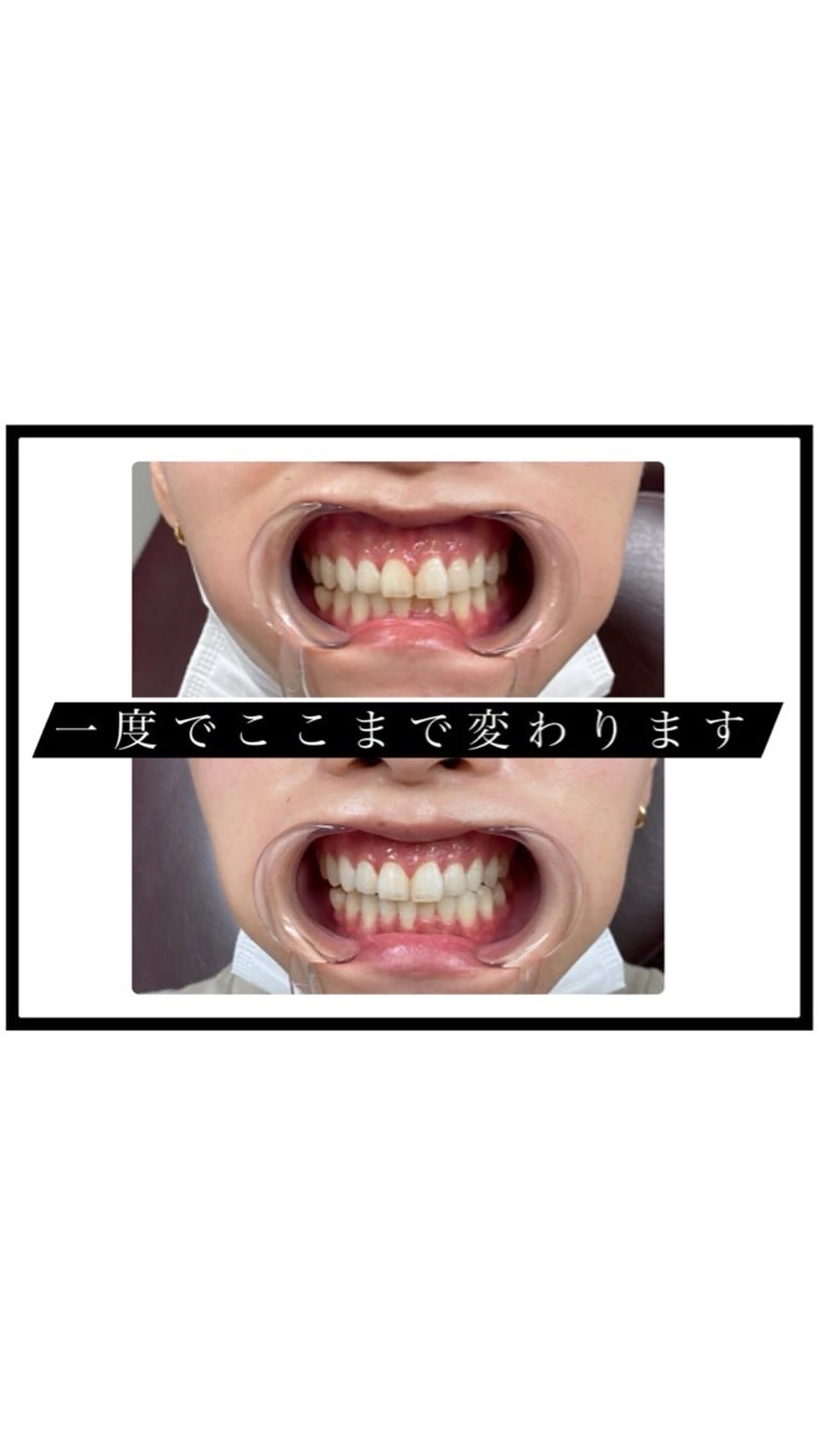 【ホワイトニング】8分1セット🦷✨の写真