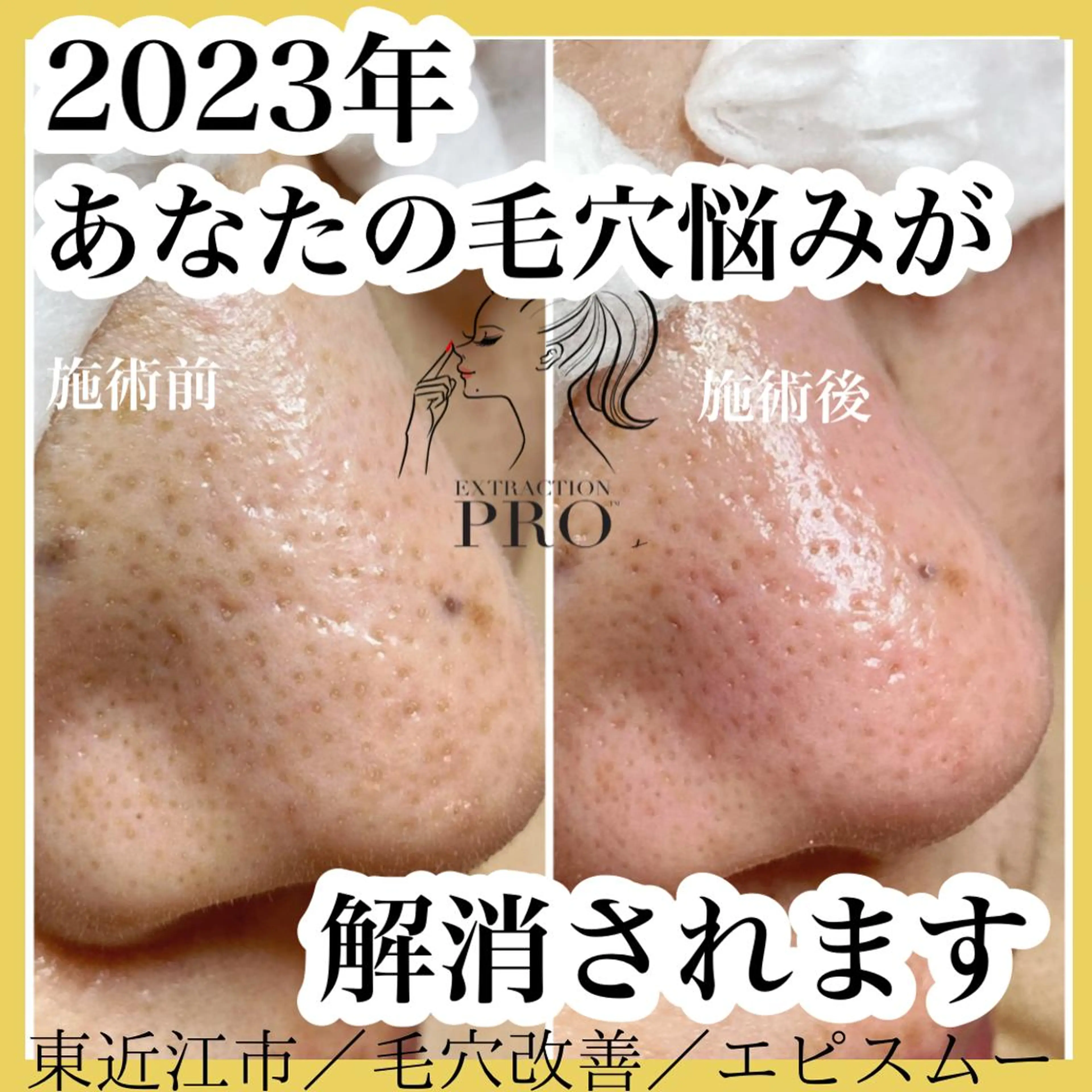 epismoo 脱毛/HBL/毛穴の眉毛・アイブロウイメージ