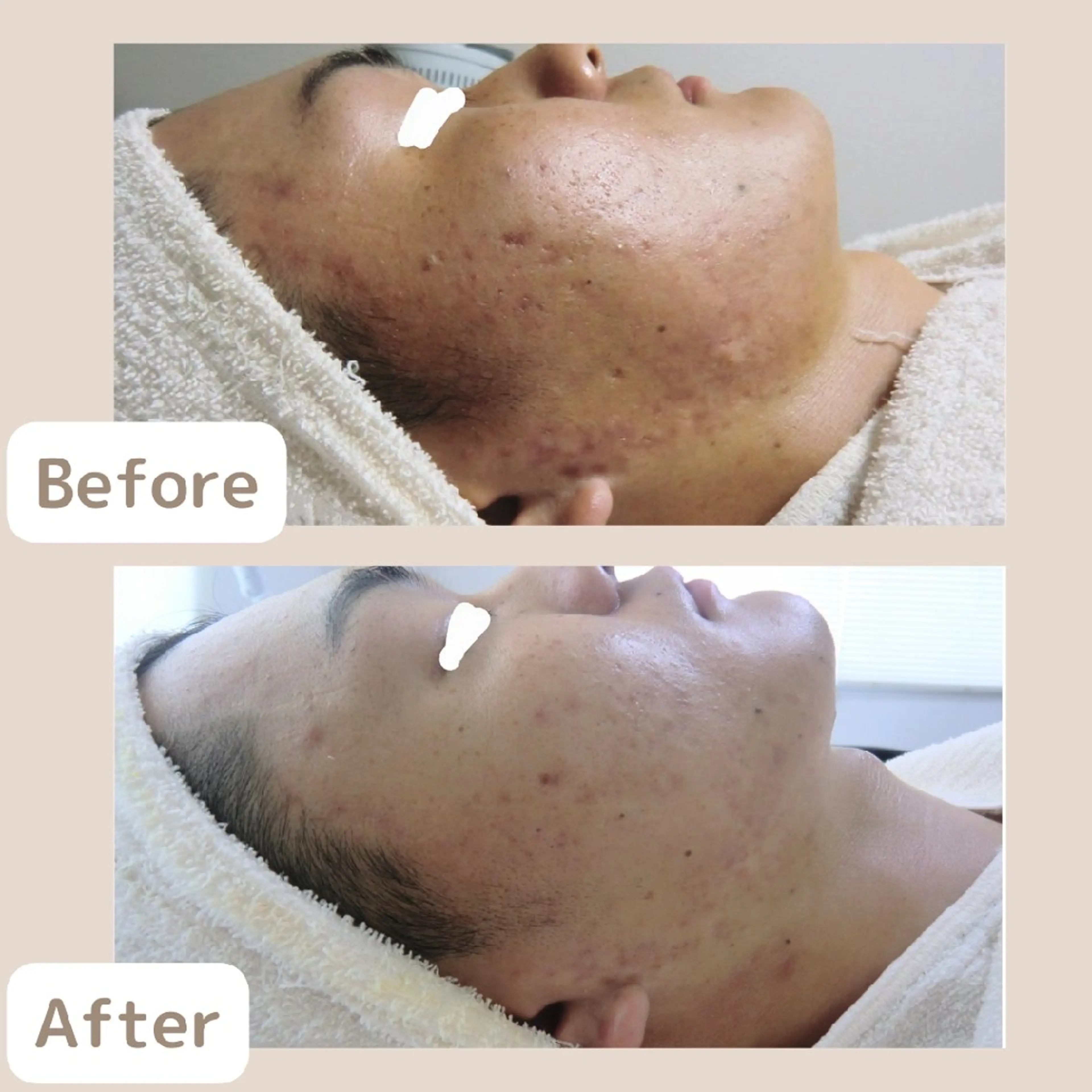 メンズ レチノール/ニキビ/ 毛穴ケア 浅川のエステ・リラクイメージ