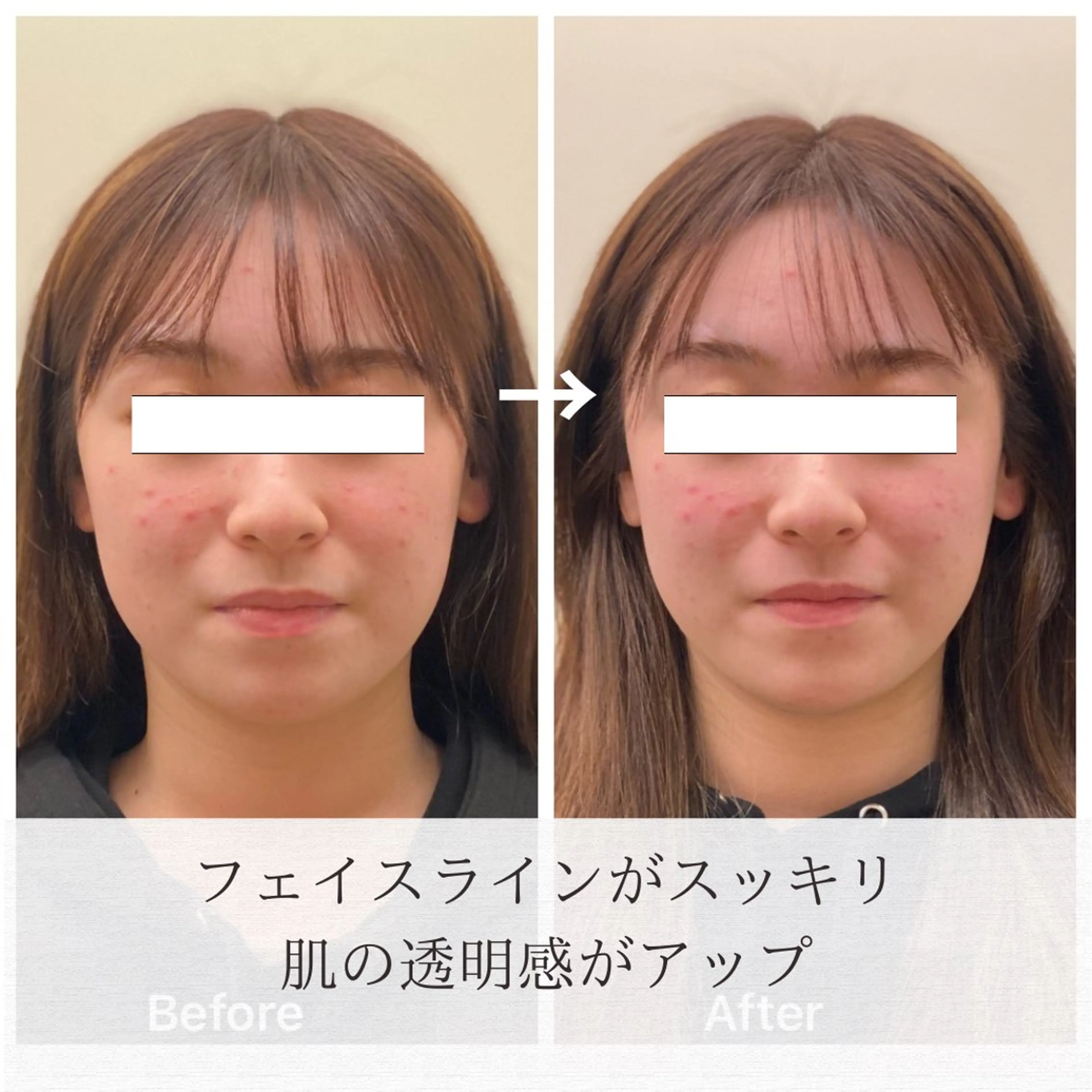 美容鍼/ヘッドスパ/ 💎さかもとのエステ・リラクイメージ