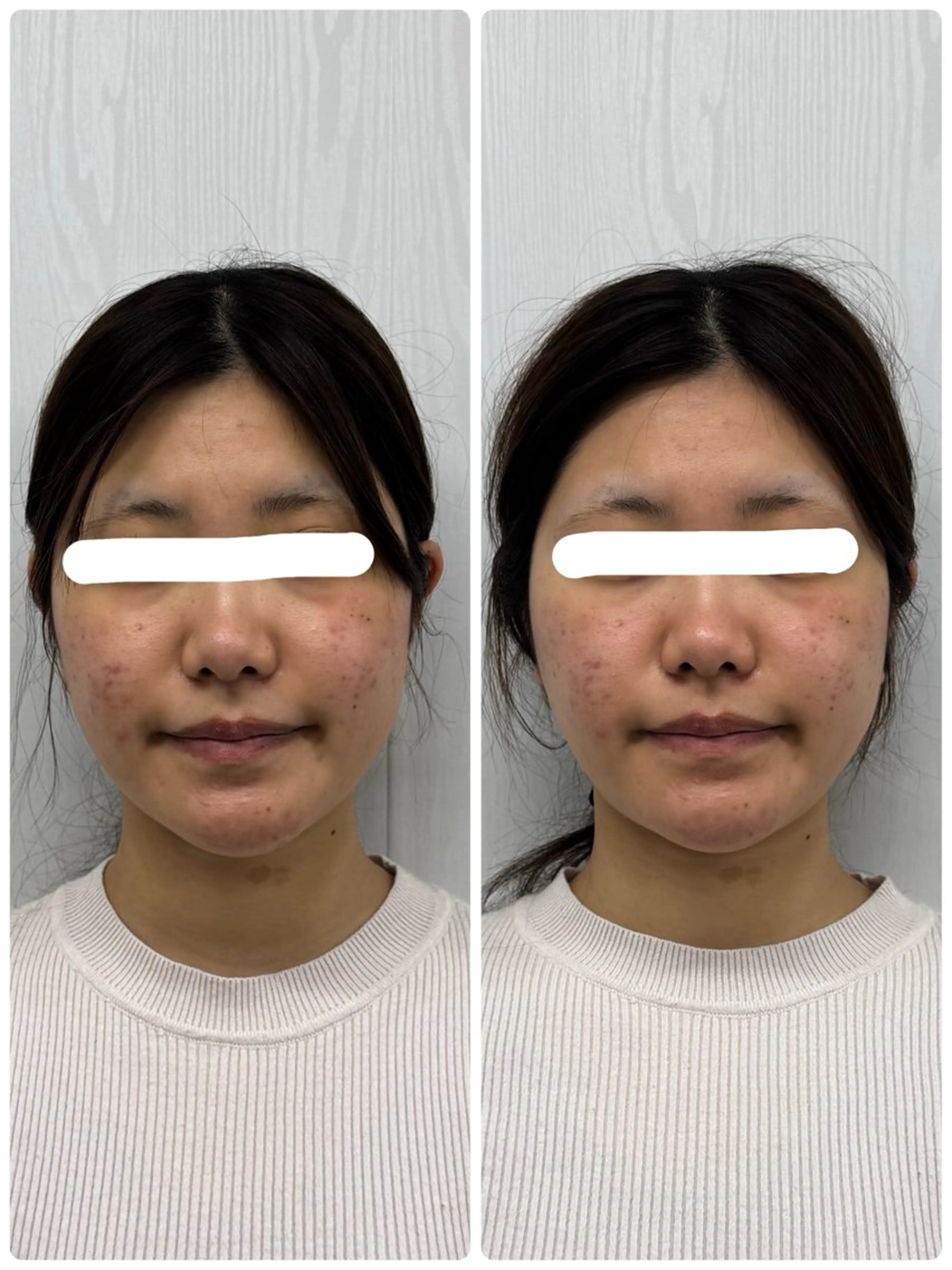 美容鍼×小顔矯正 ×美容整体　浜川泰仁のエステ・リラクイメージ