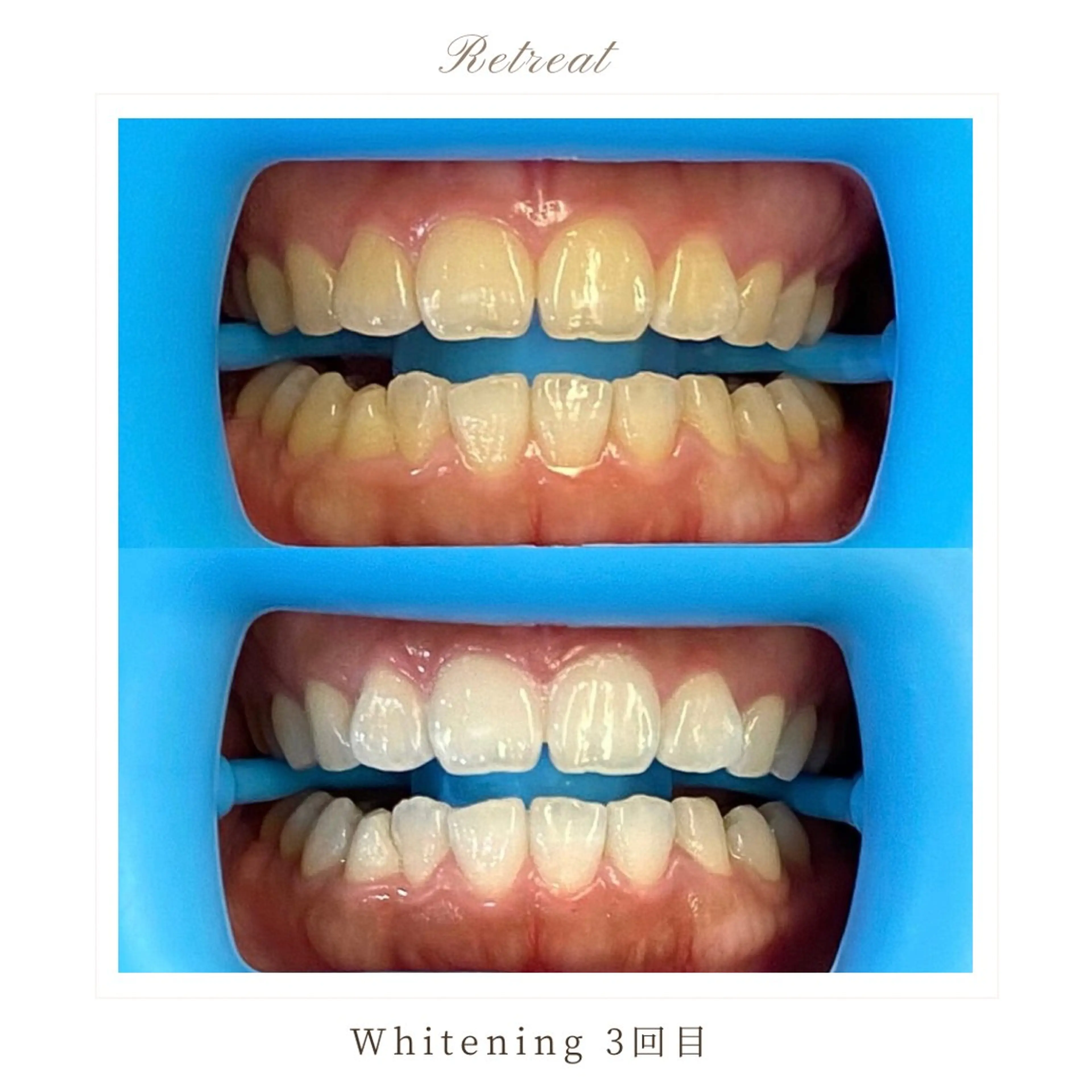 💎12月末まで💎【煙草・珈琲毎日飲む方】プレミアム3回コース 1回/¥7,700の写真