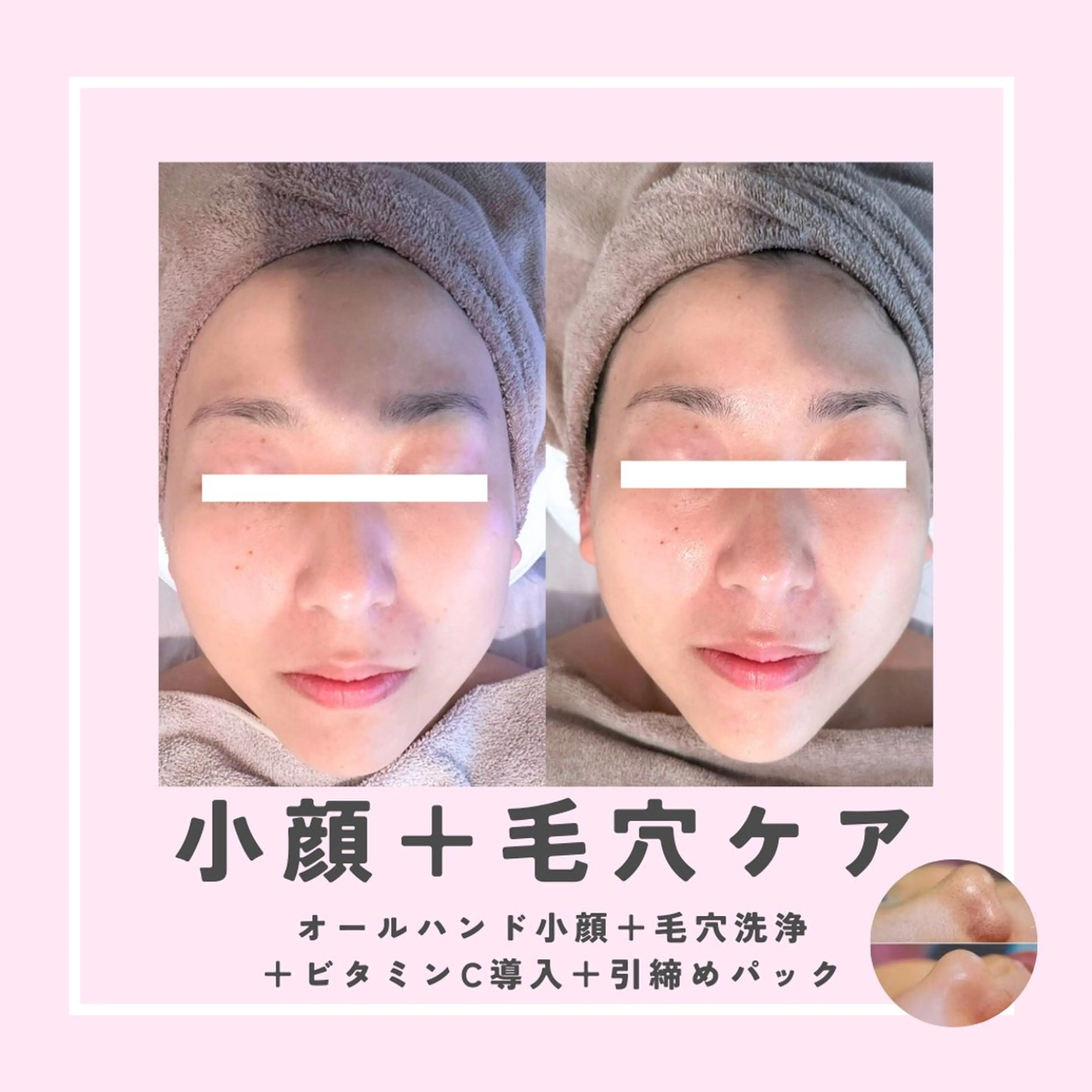 〈小顔✖︎毛穴〉オールハンド小顔ケア+毛穴洗浄+美容液導入　90分 7,000円の写真