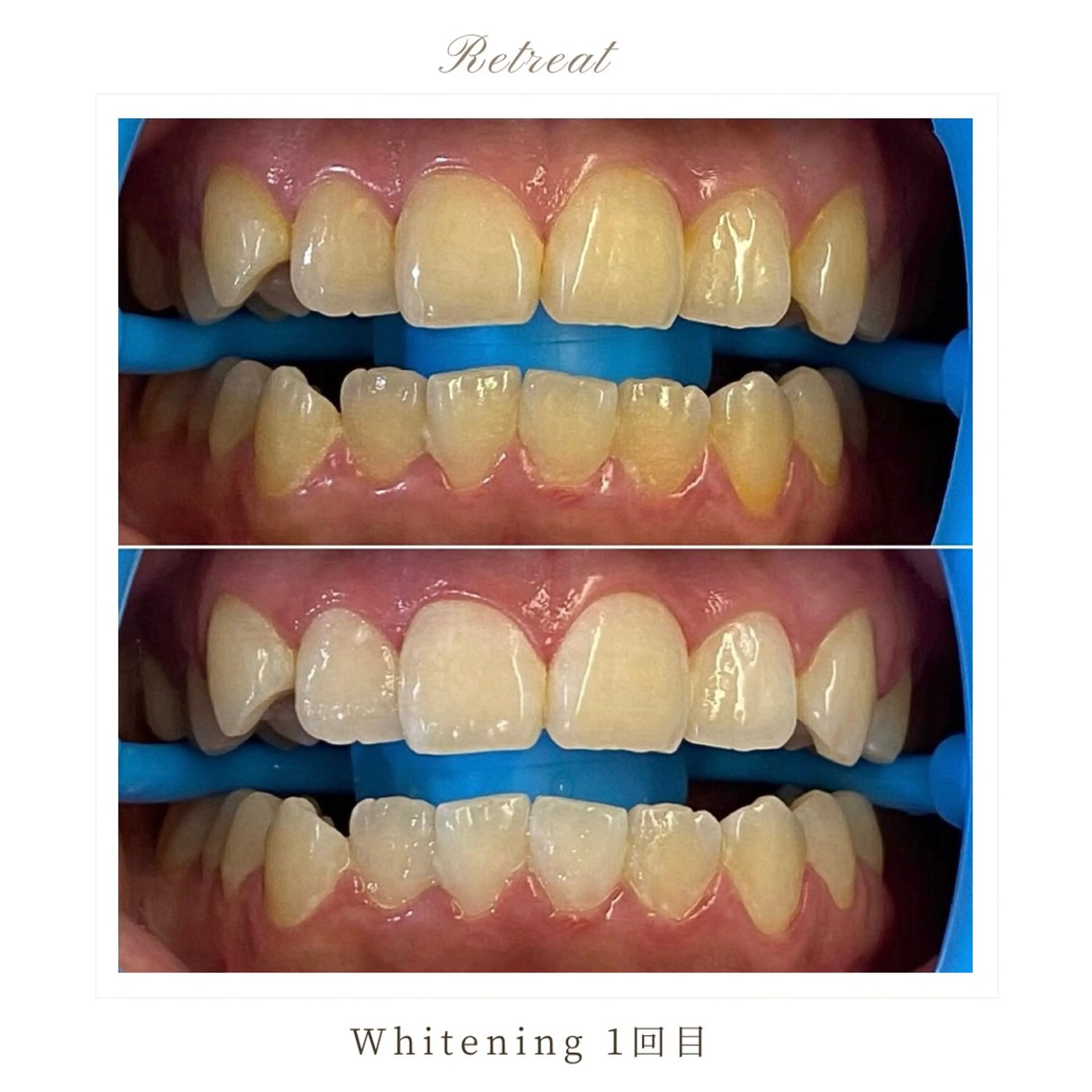 【ホワイトニング初めての方へ】ライトコース 1回/4回照射の写真