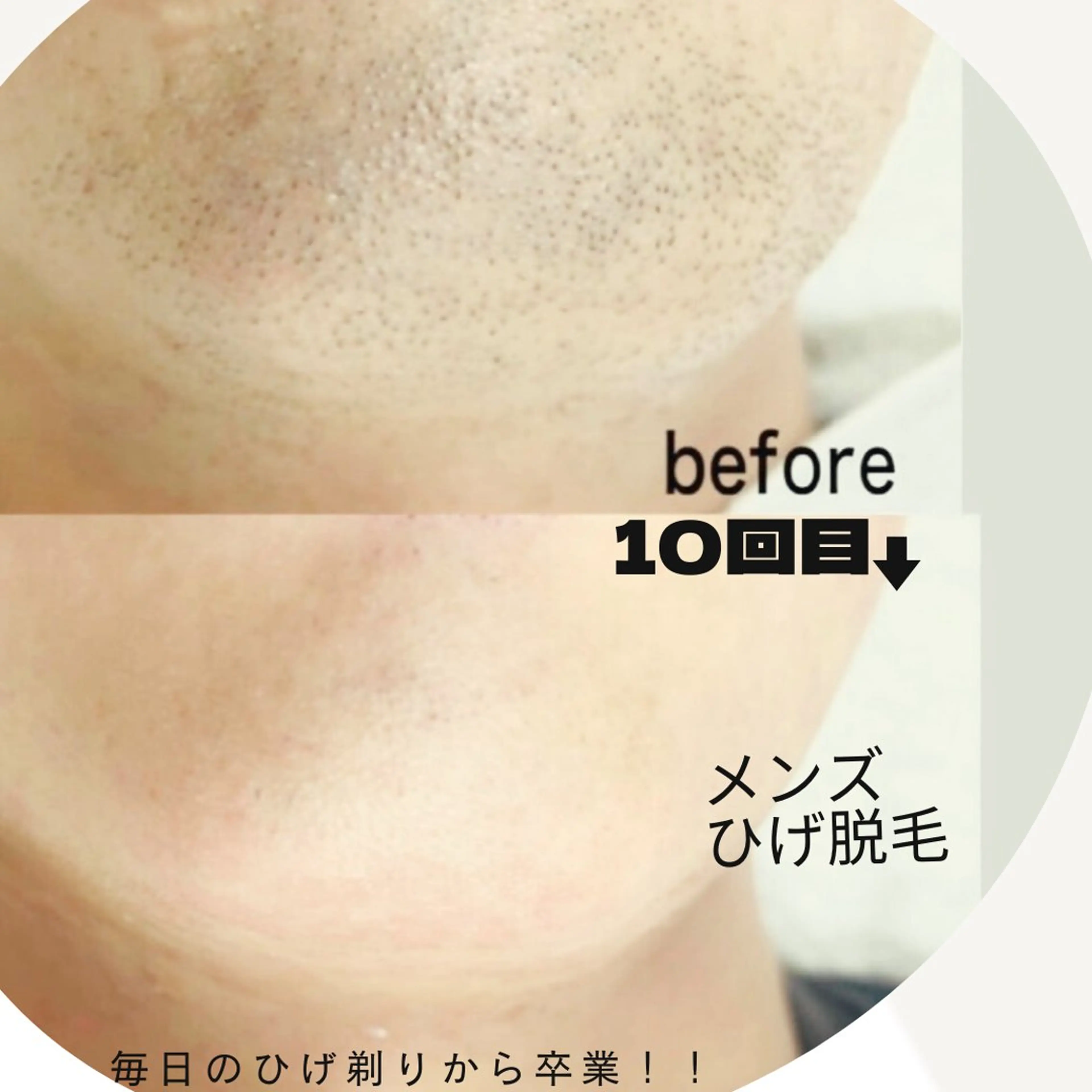 メンズひげ脱毛の写真