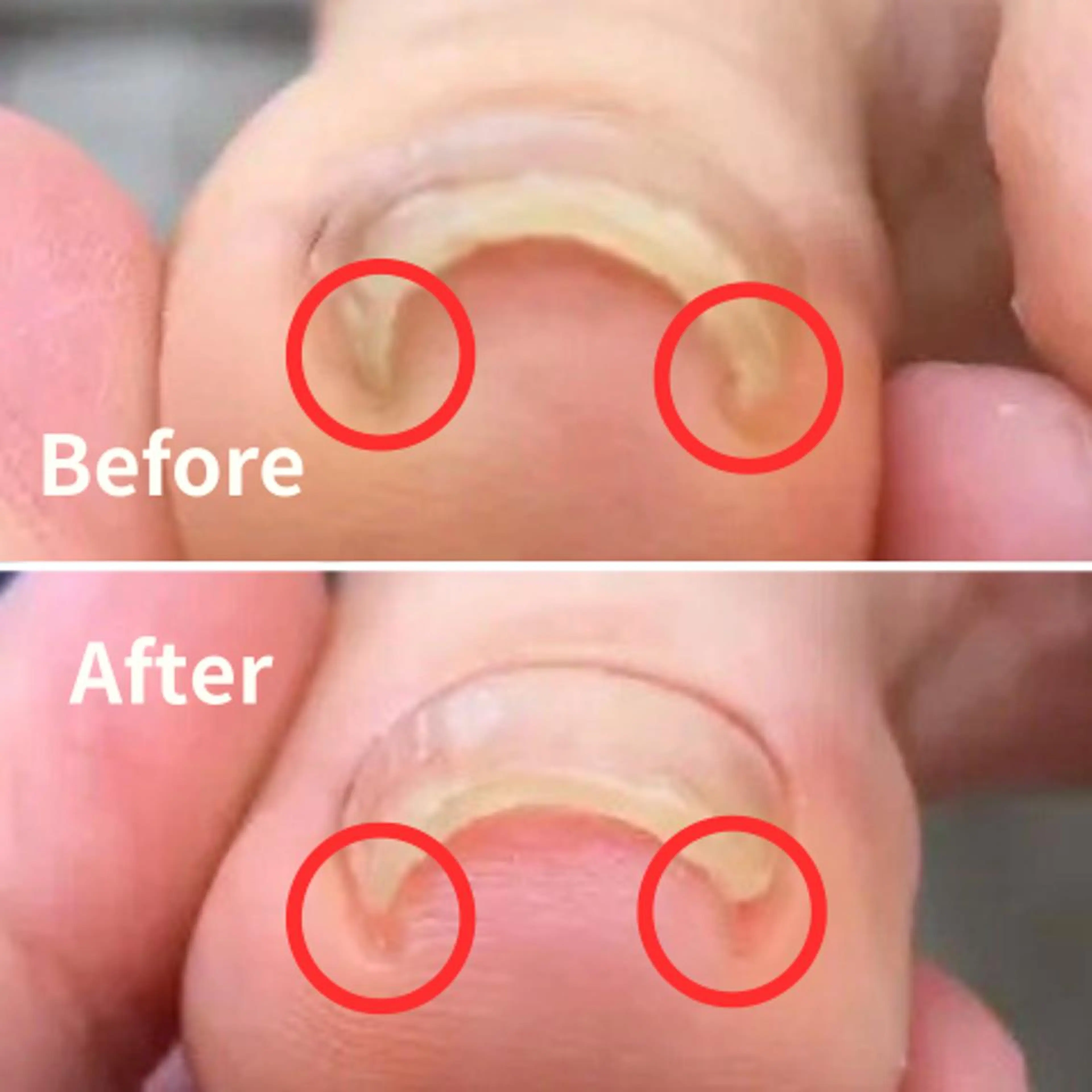 ☘️痛みを緩和☘️【巻き爪ケア】モデルの写真