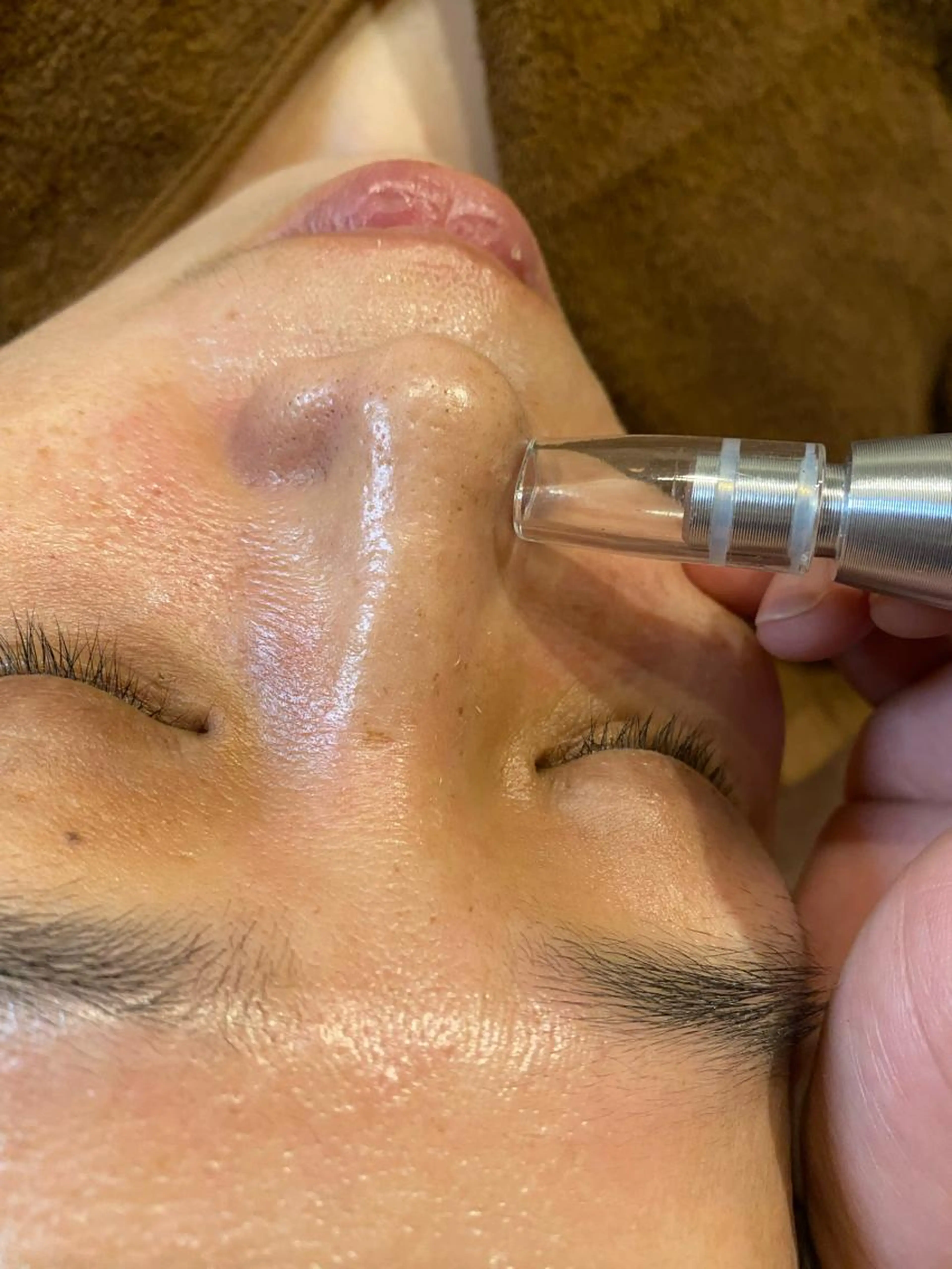 毛穴ケア《石膏パック付き》の写真