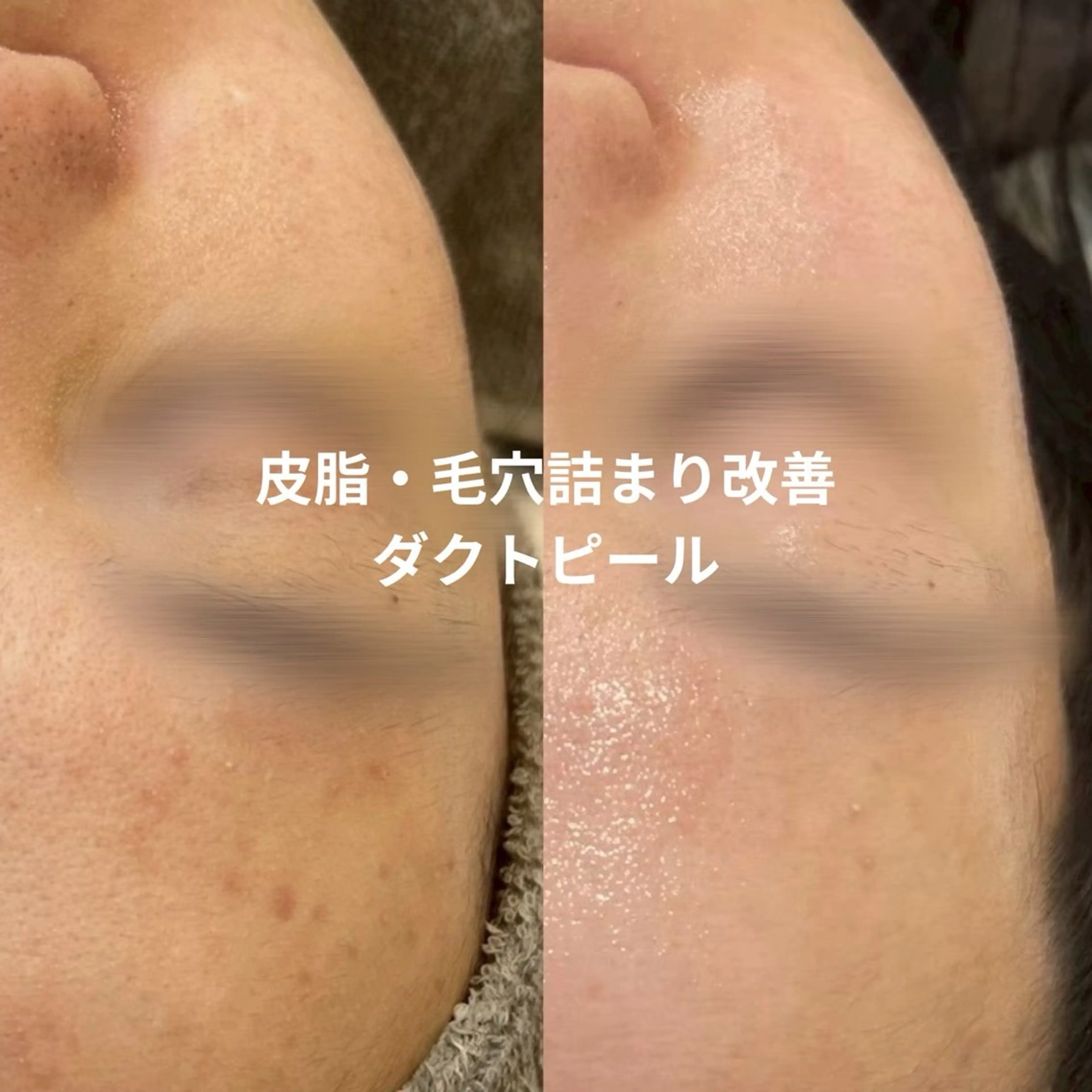 💜モニター限定価格💜ダクトピール|年齢サインにアプローチする特別ケアの写真