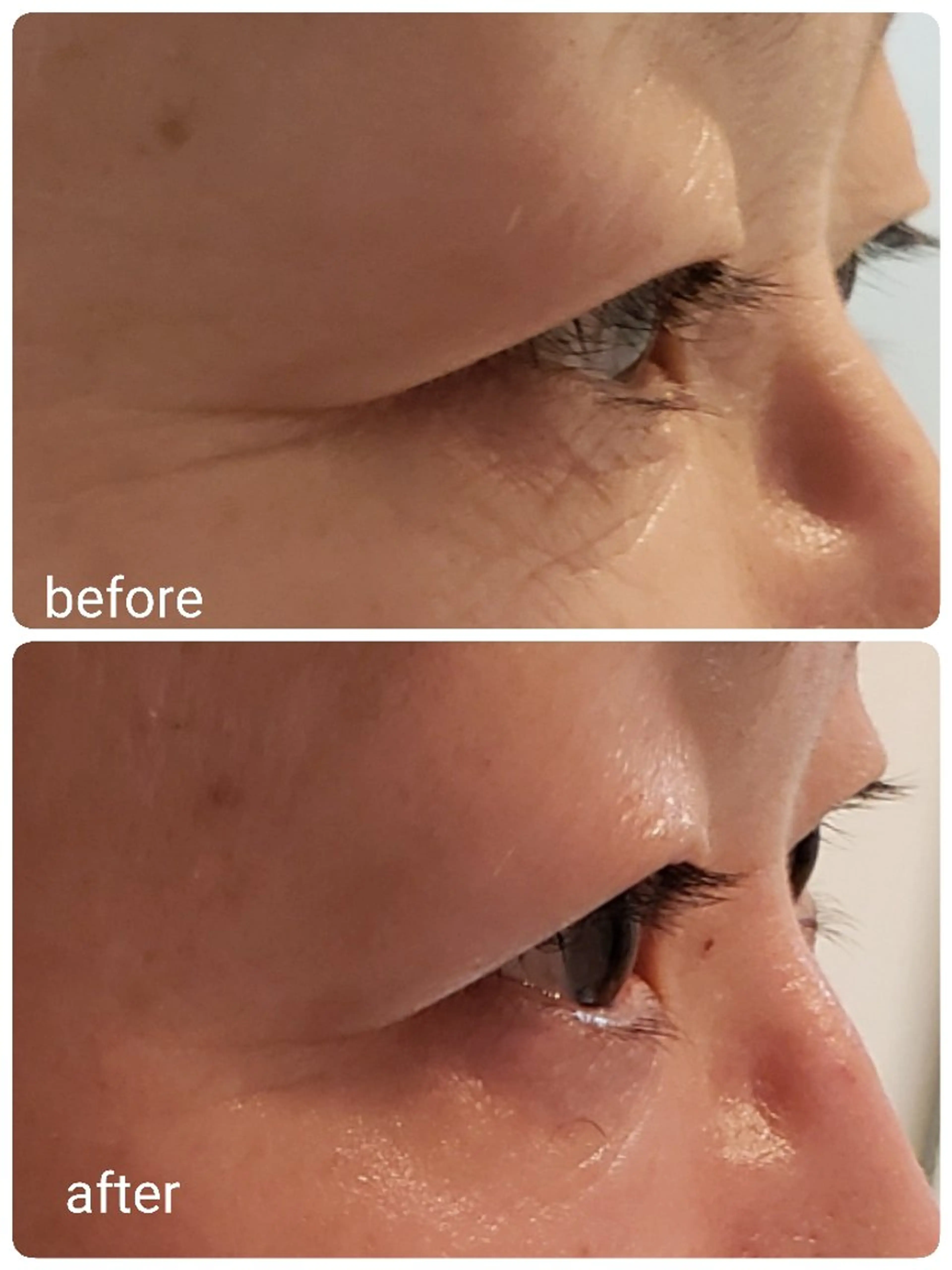 【むくみ】フェイシャル　ハーブピーリングの写真