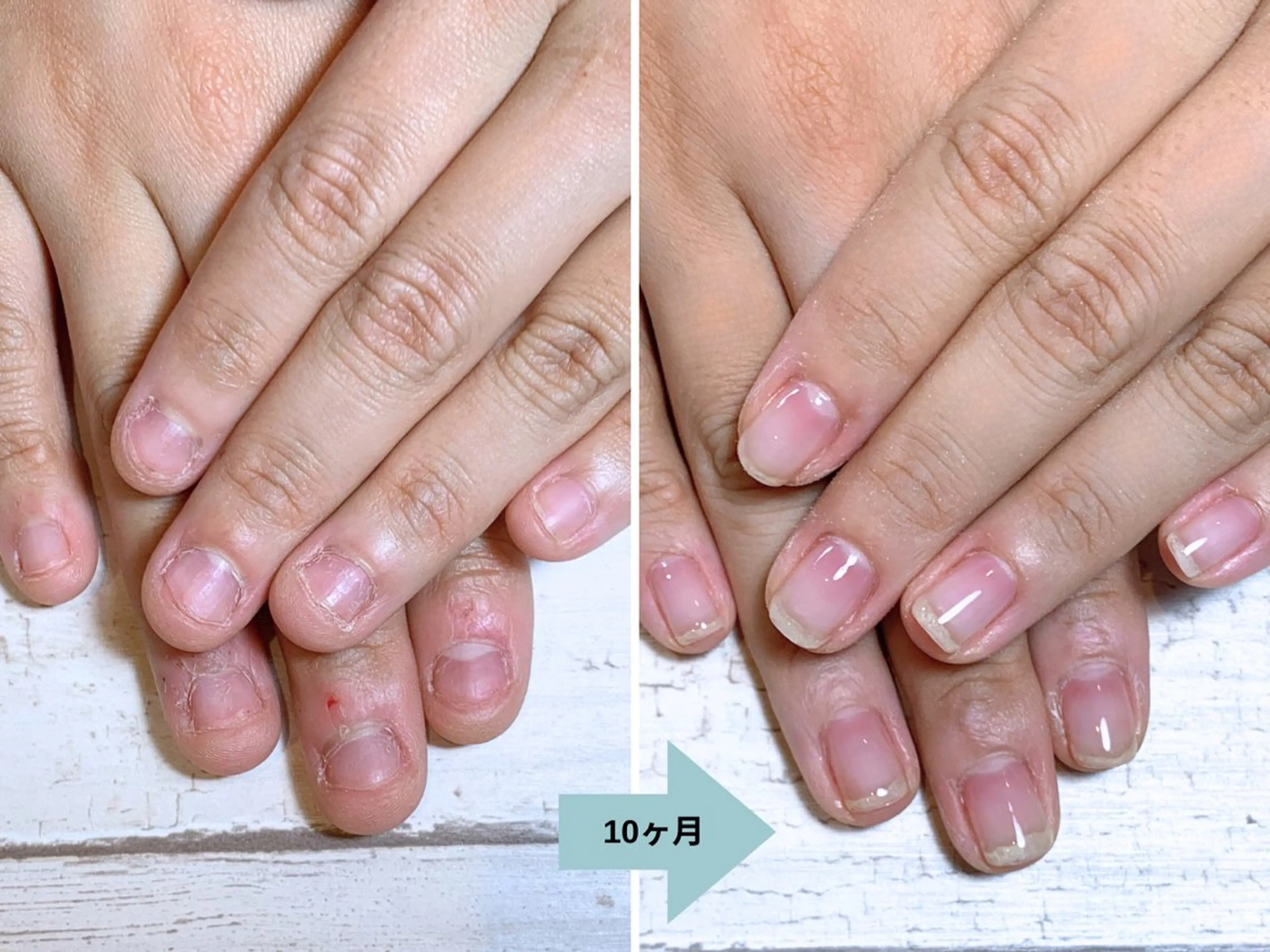 ネイル 深爪矯正・自爪育成 ネイルサロンアモここのネイルデザイン