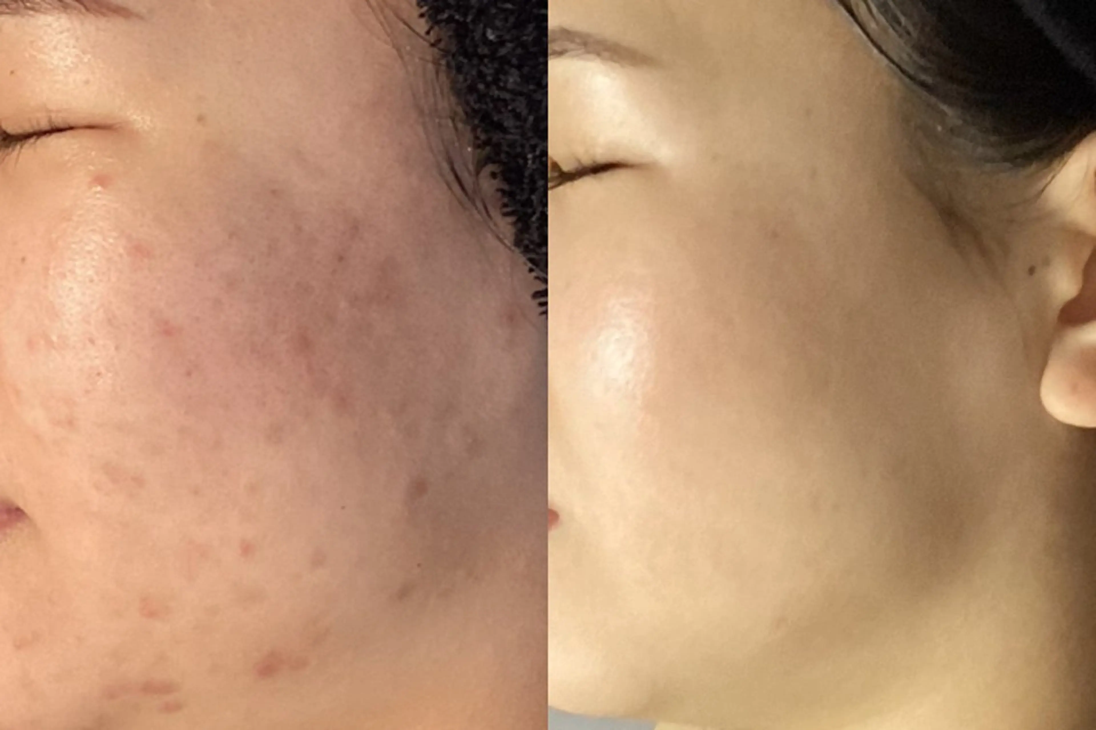 エステ 池袋ニキビ毛穴改善 🌿ハーブピーリングのエステ・リラクイメージ