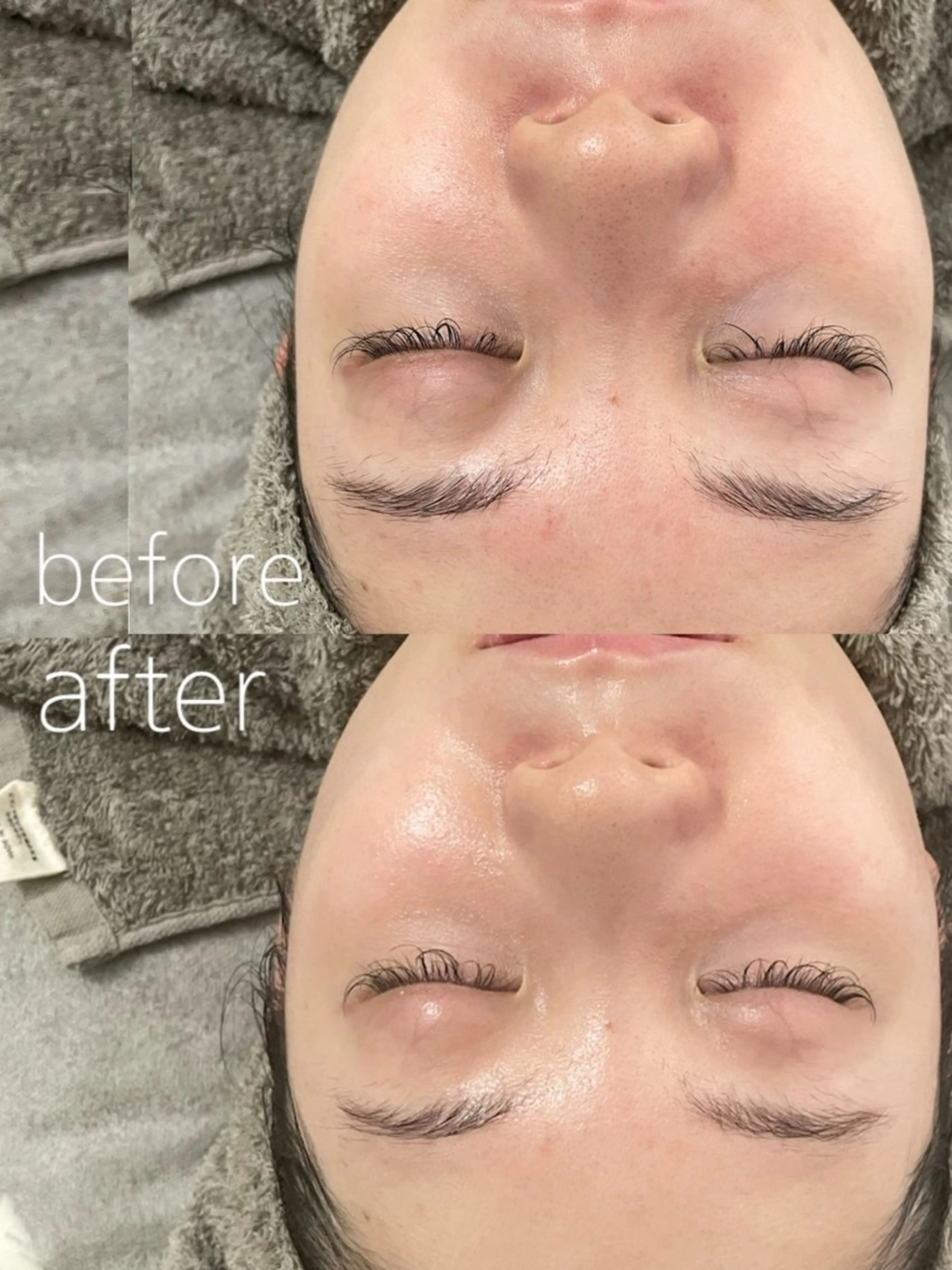 🩵赤み·かゆみ·乾燥🩵乳酸菌ピーリングでバリア機能を修復×強化✨✨艶々潤い水光肌へ導きます🤍🫧の写真