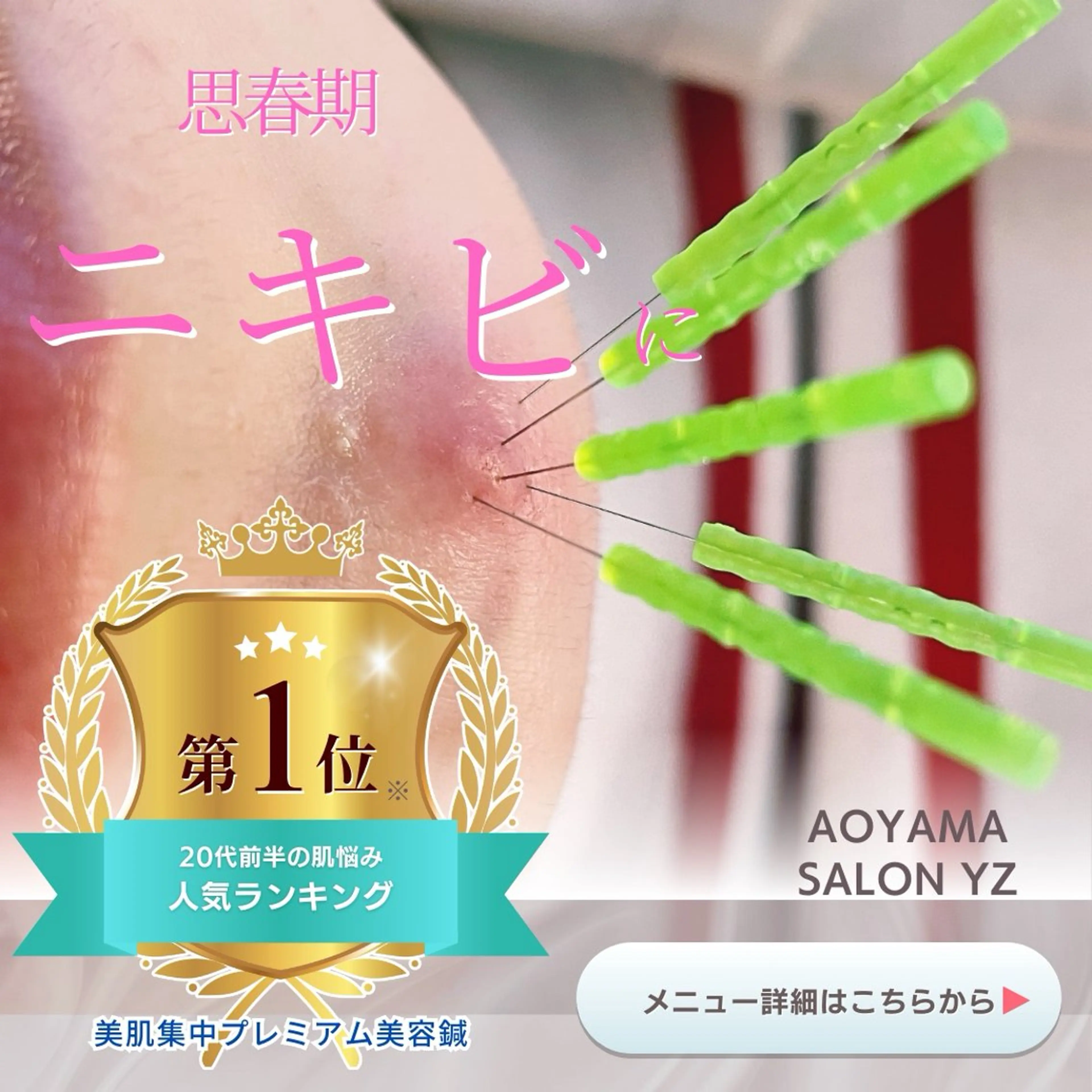 🔹美肌集中プレミアム美容鍼🔹繰り返す青春ニキビを改善するならコレ✨の写真