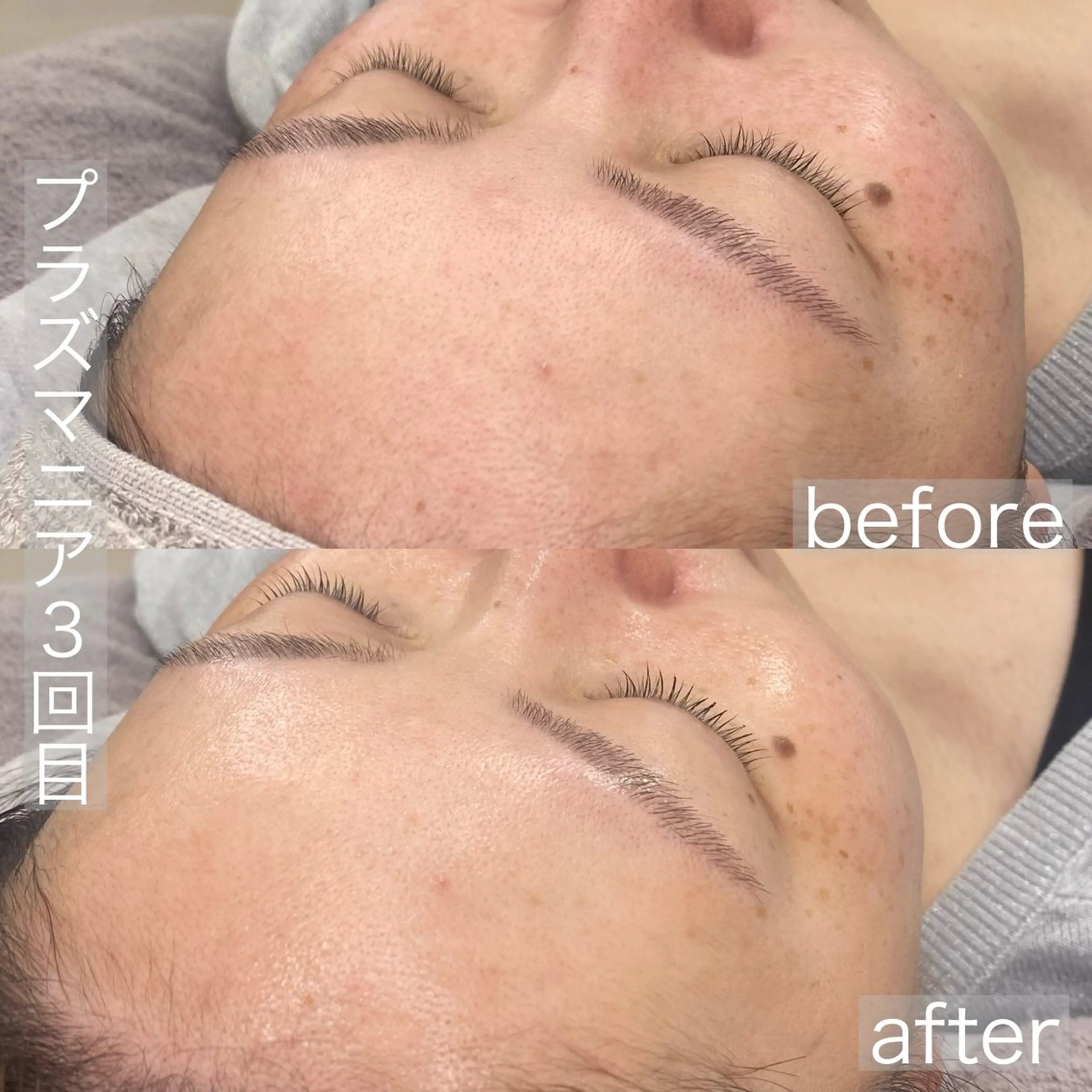 【プラズマニア】肝斑・くすみ撃退で艶肌へ！最先端美容19000円→10000円の写真