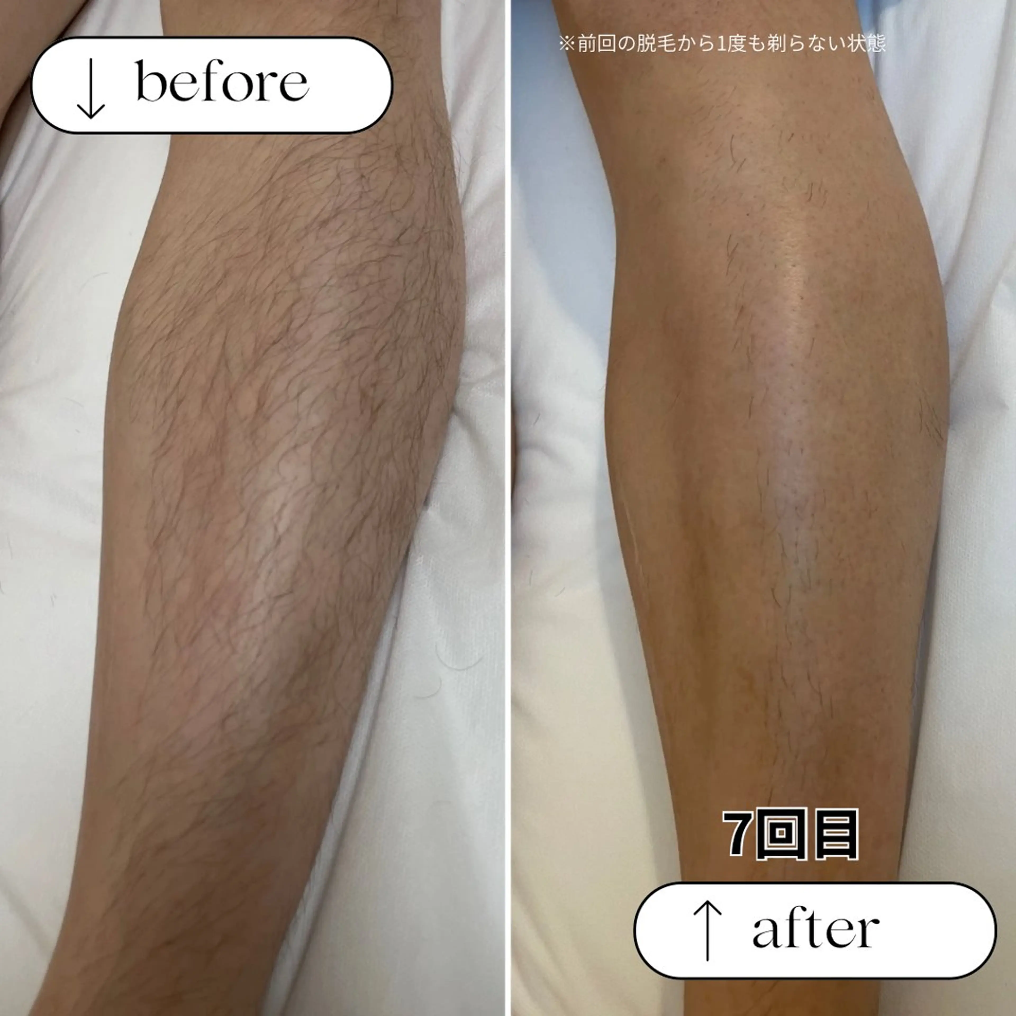 【men's脱毛】脚　¥5000(通常¥7000)の写真