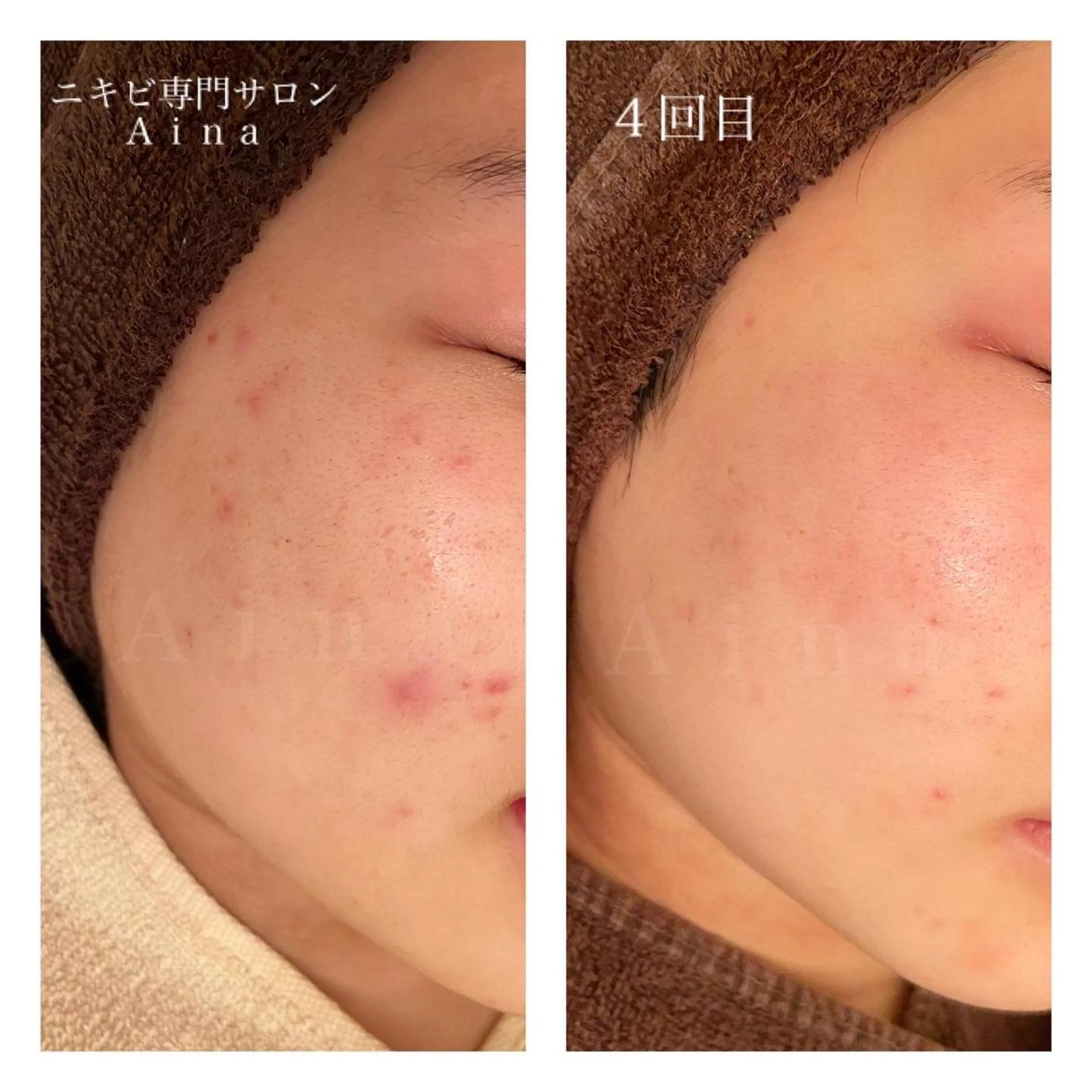 ミディアム カラー パーマ ヘアアレンジ メンズ ネイル マツエク・マツパ エステ リラク ニキビ跡専門サロン Ａｉｎａのエステ・リラクイメージ