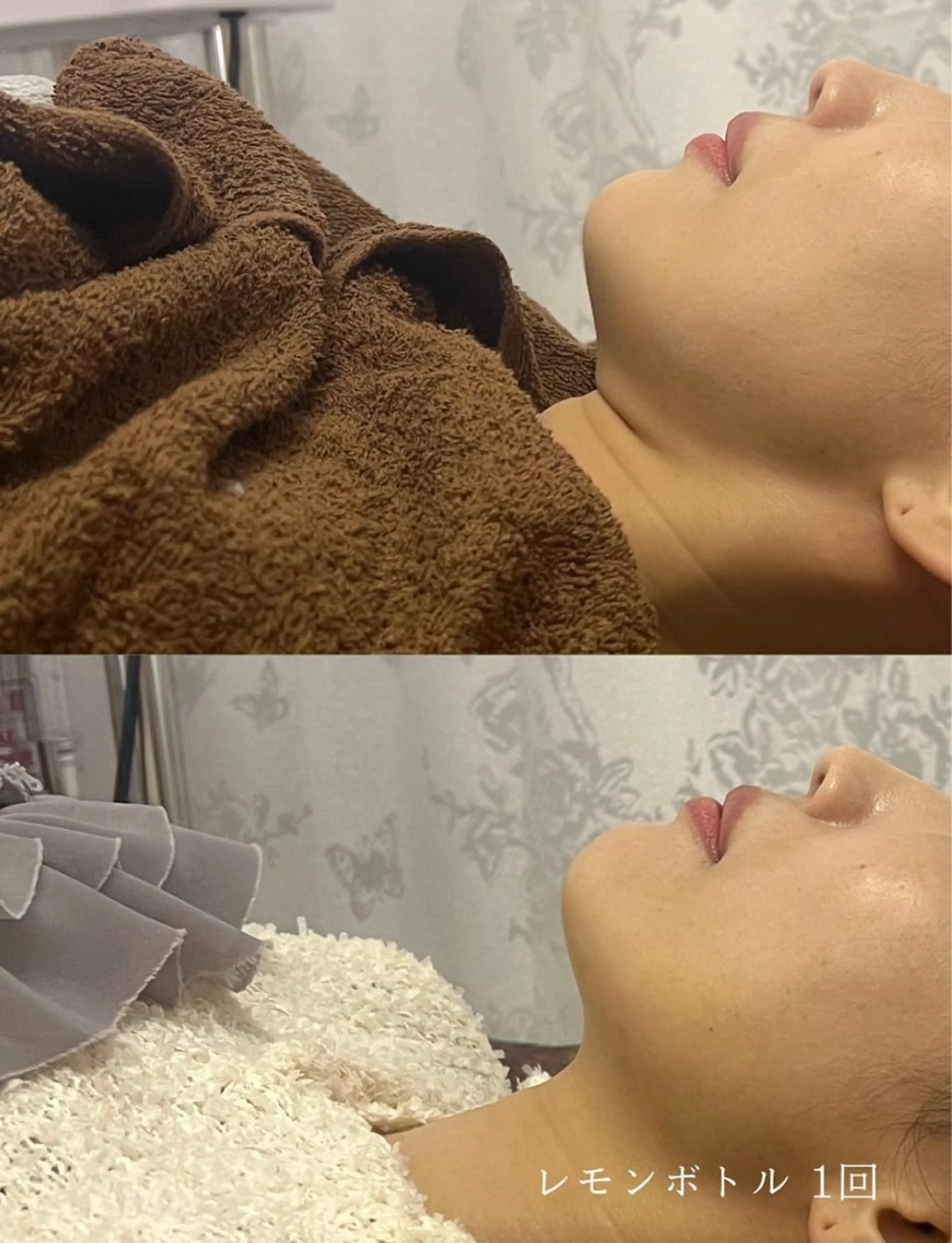 【初回特別価格‼️】脂肪細胞アプローチ🍋小顔施術でリバウンドなし🙆‍♀️✨の写真