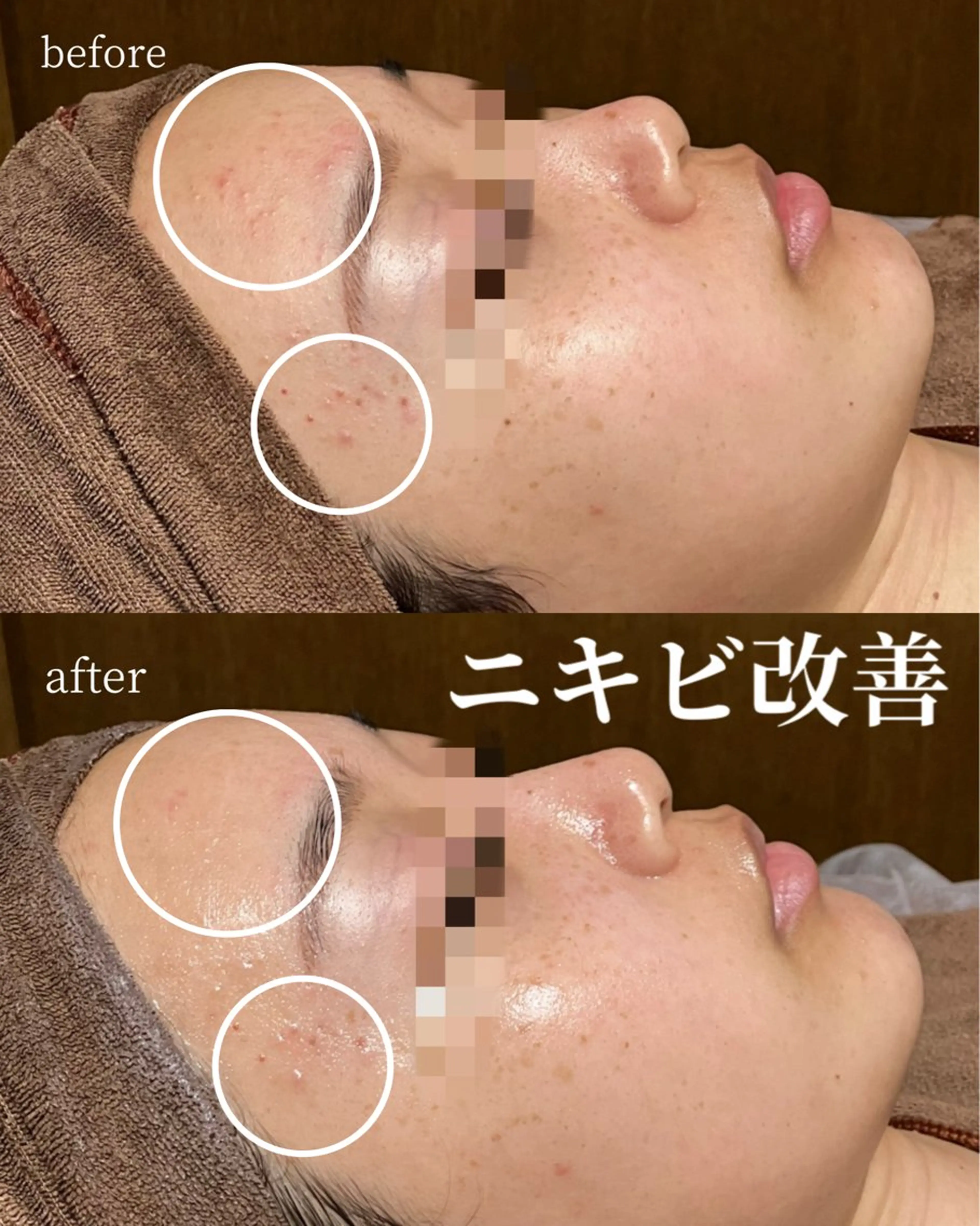 【モニター様大募集✨️】肌荒れ/赤ニキビ/ニキビ跡 でお悩みの方におすすめトリートメント🎶の写真